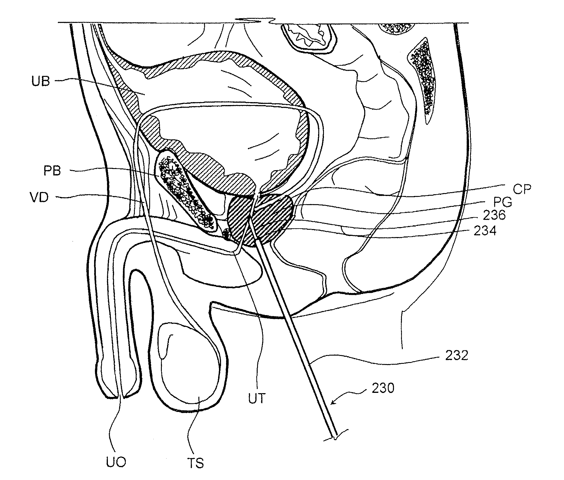 Devices, systems and methods for treating benign prostatic hyperplasia and other conditions