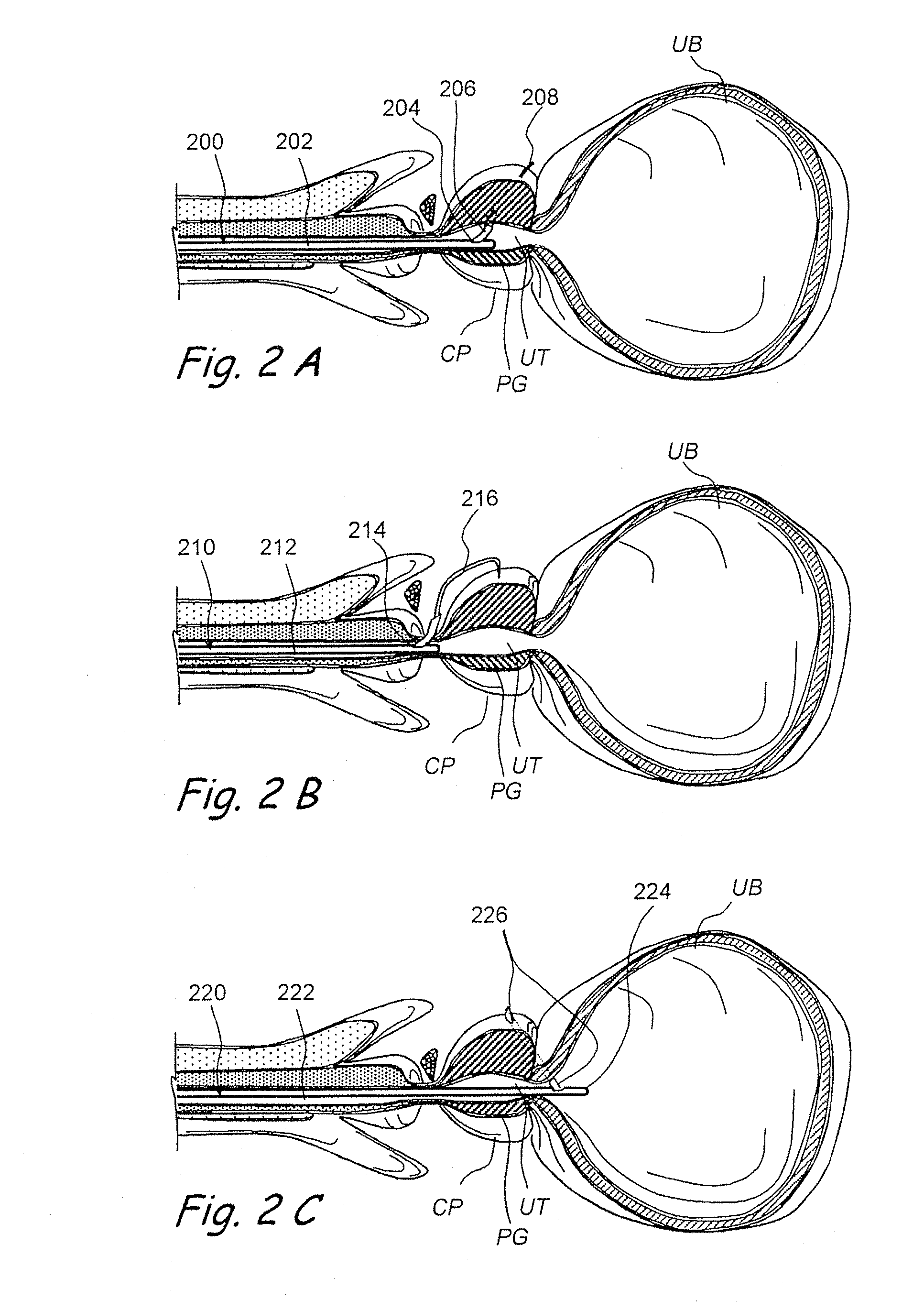 Devices, systems and methods for treating benign prostatic hyperplasia and other conditions