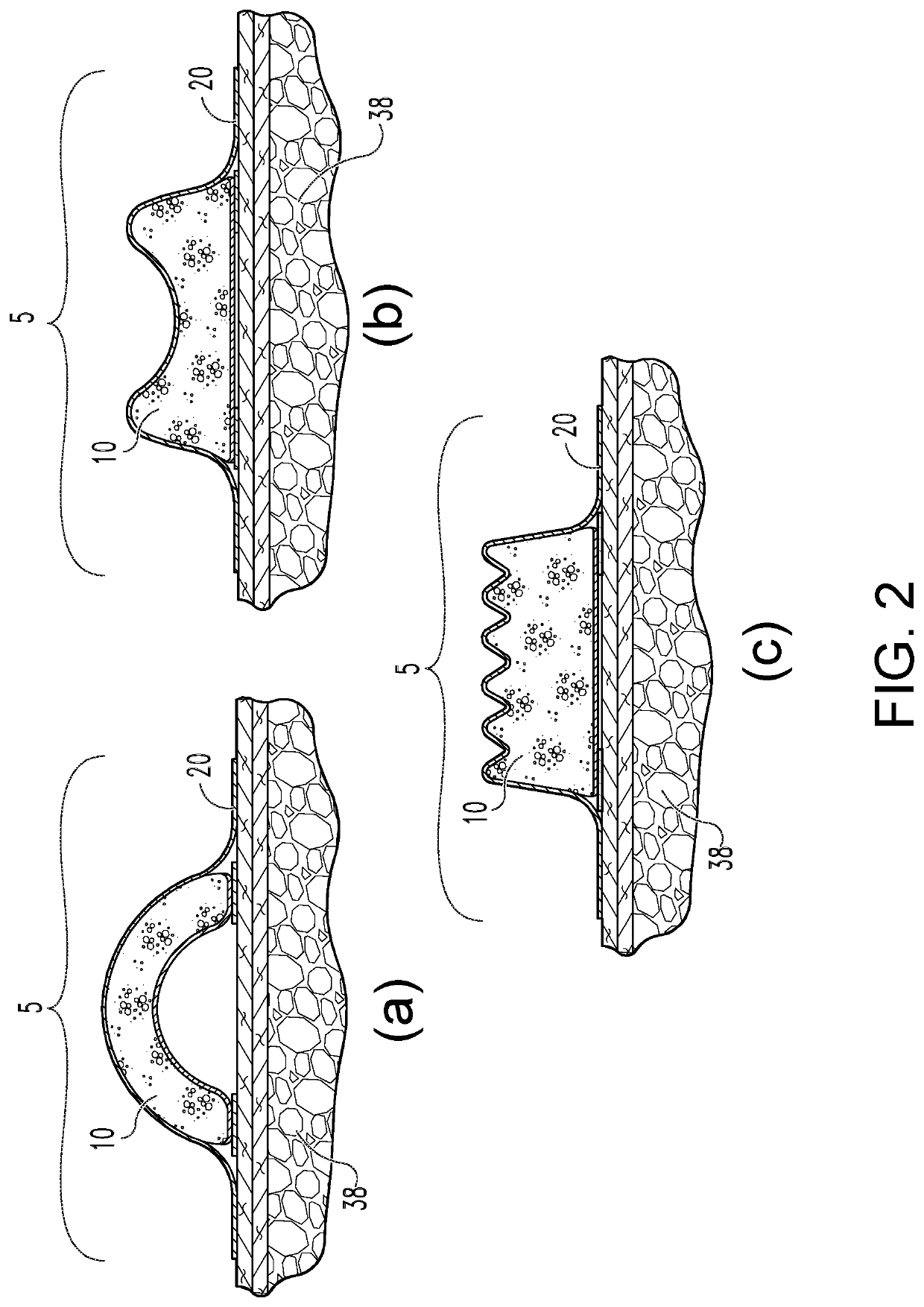 Negative pressure wound apposition dressing system