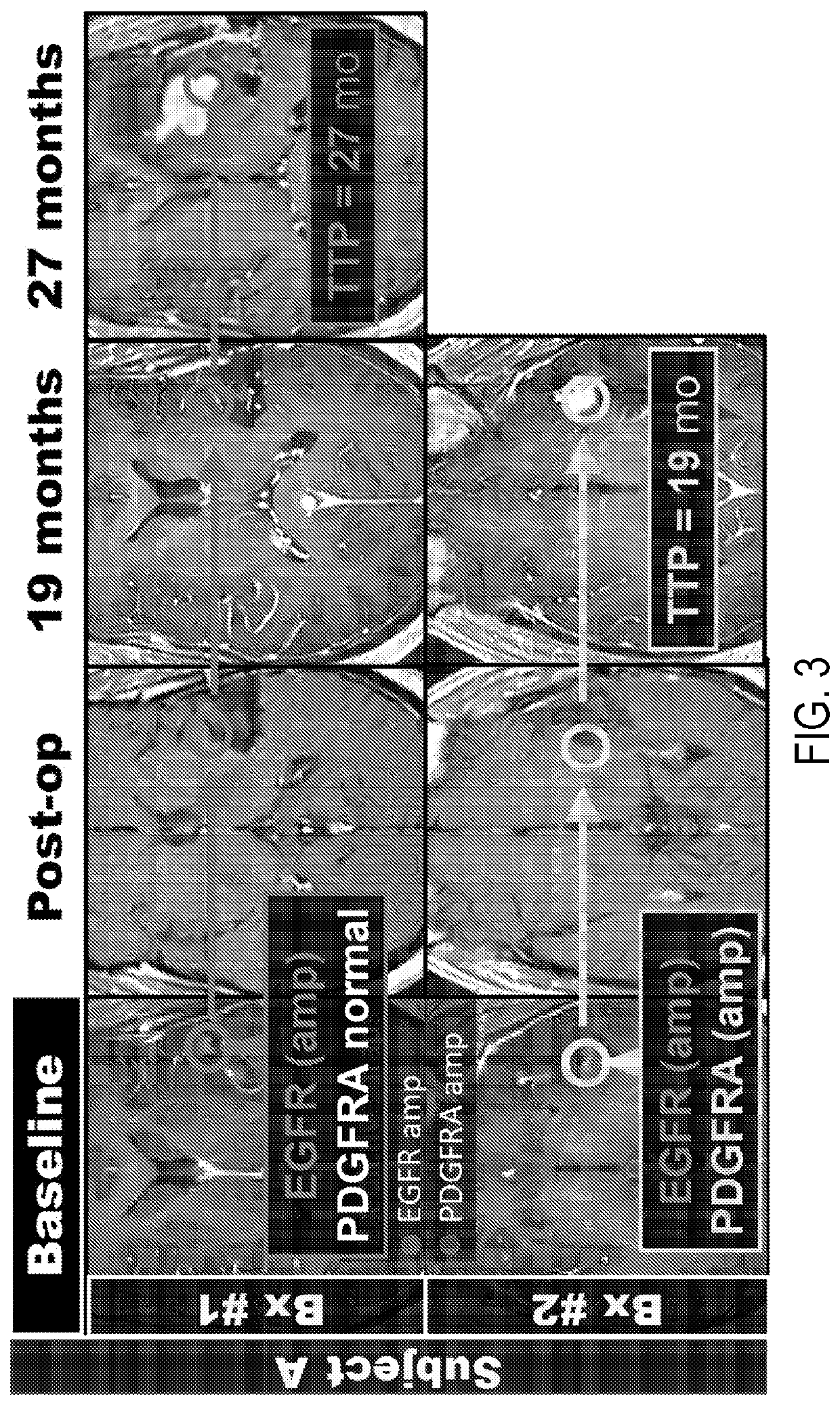 Systems and Methods for Quantifying Multiscale Competitive Landscapes of Clonal Diversity in Glioblastoma