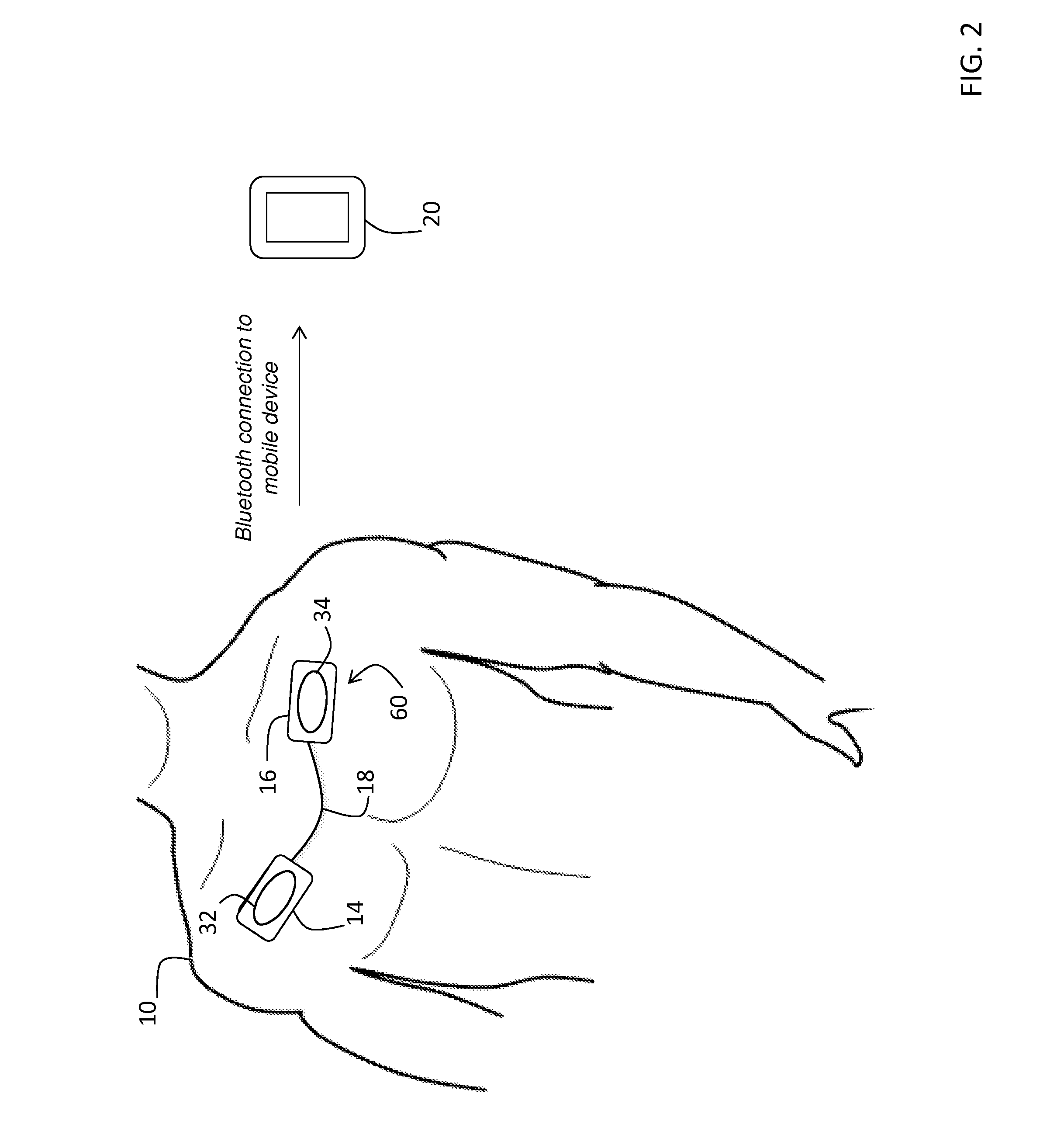 System for electrophysiology that includes software module and body-worn monitor