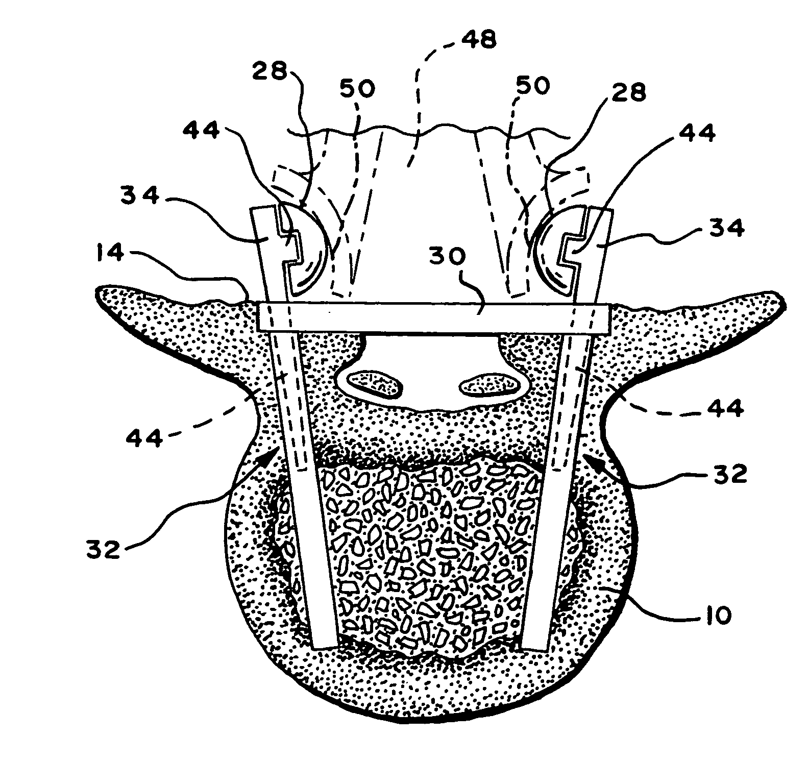 Facet arthroplasty devices and methods