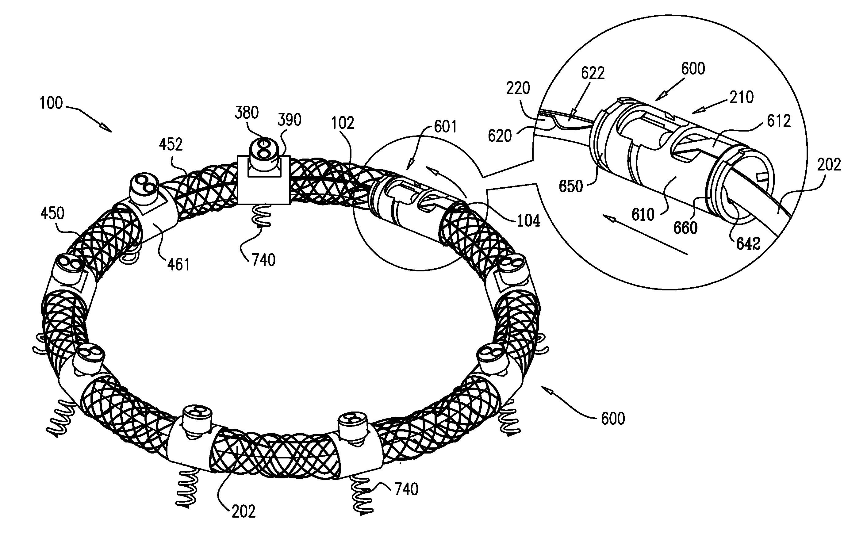 Implant and anchor placement