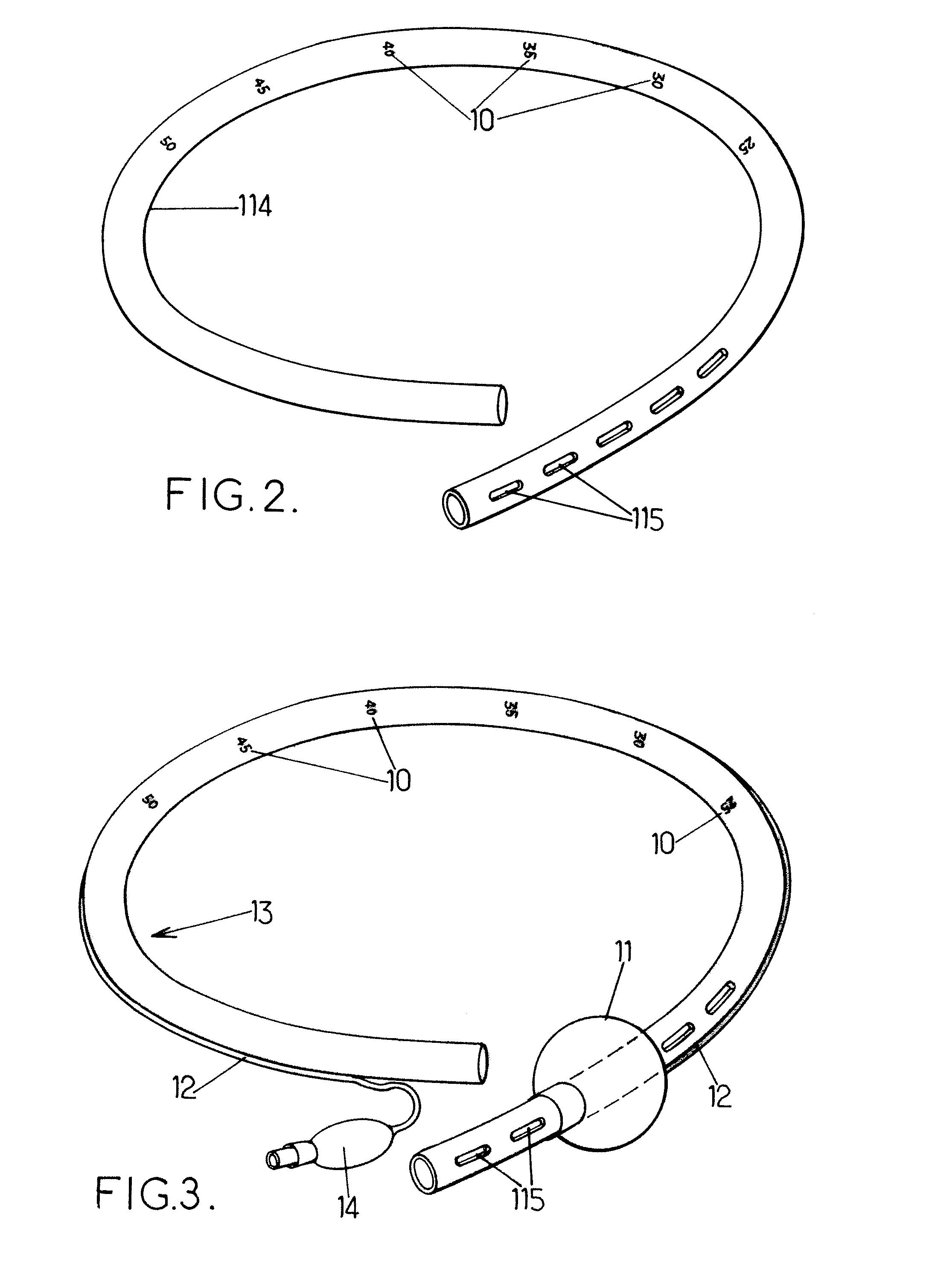 Orogastric catheter for longitudinal gastrectomy