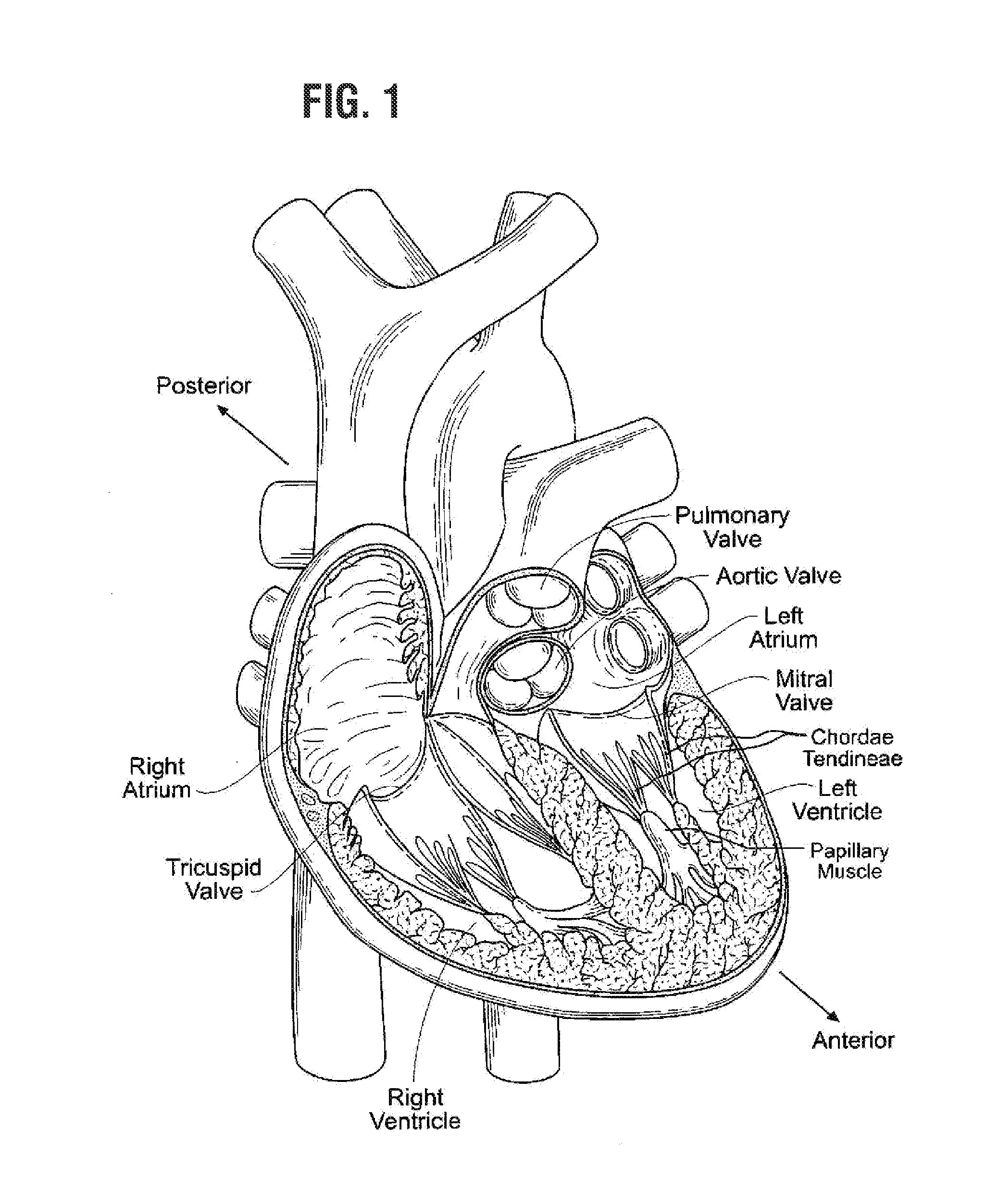 Rapidly deployable surgical heart valves