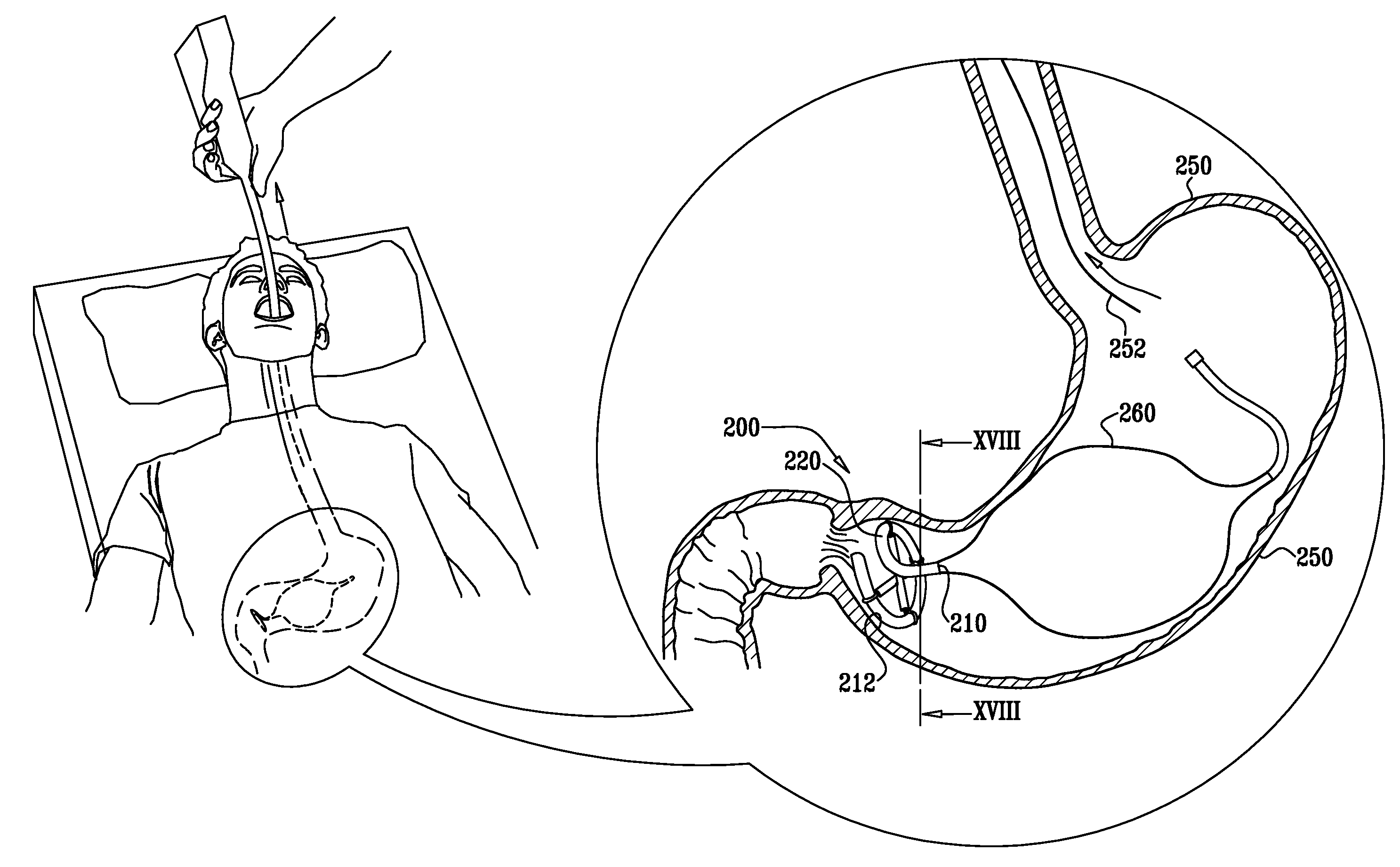 Floating gastrointestinal anchor