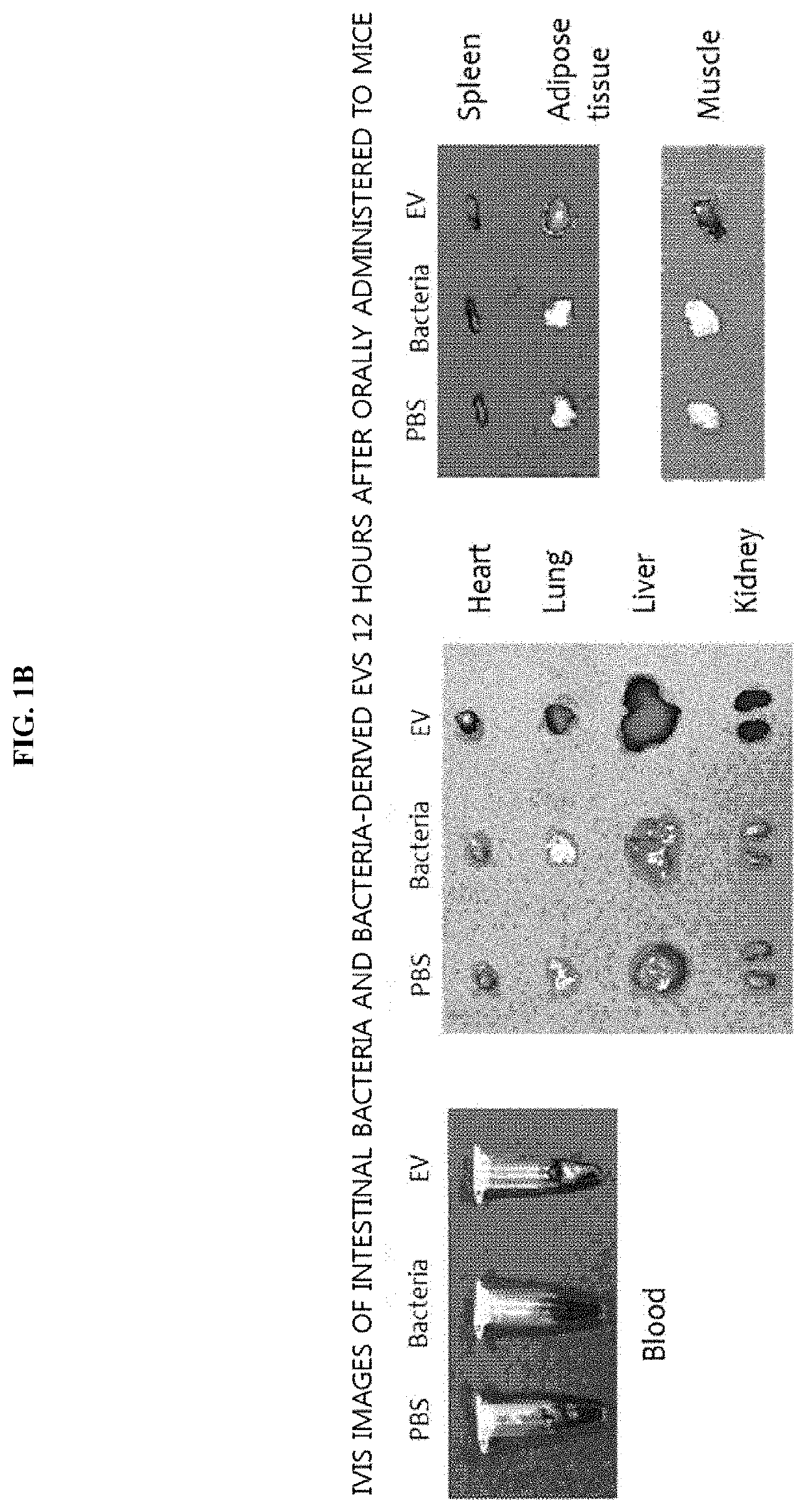 Method for diagnosis of stroke through bacterial metagenome analysis