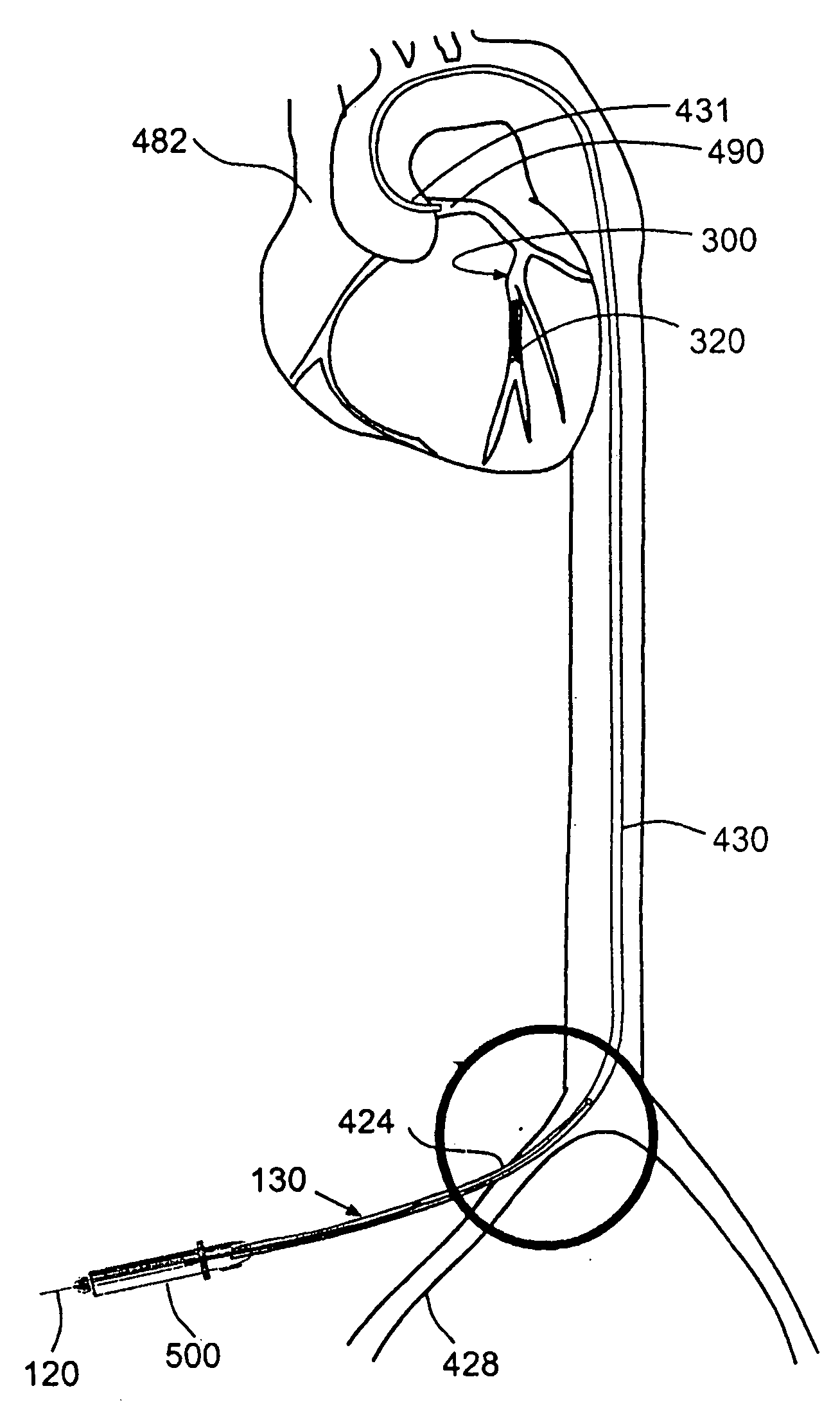 Blood vessel occlusion auger