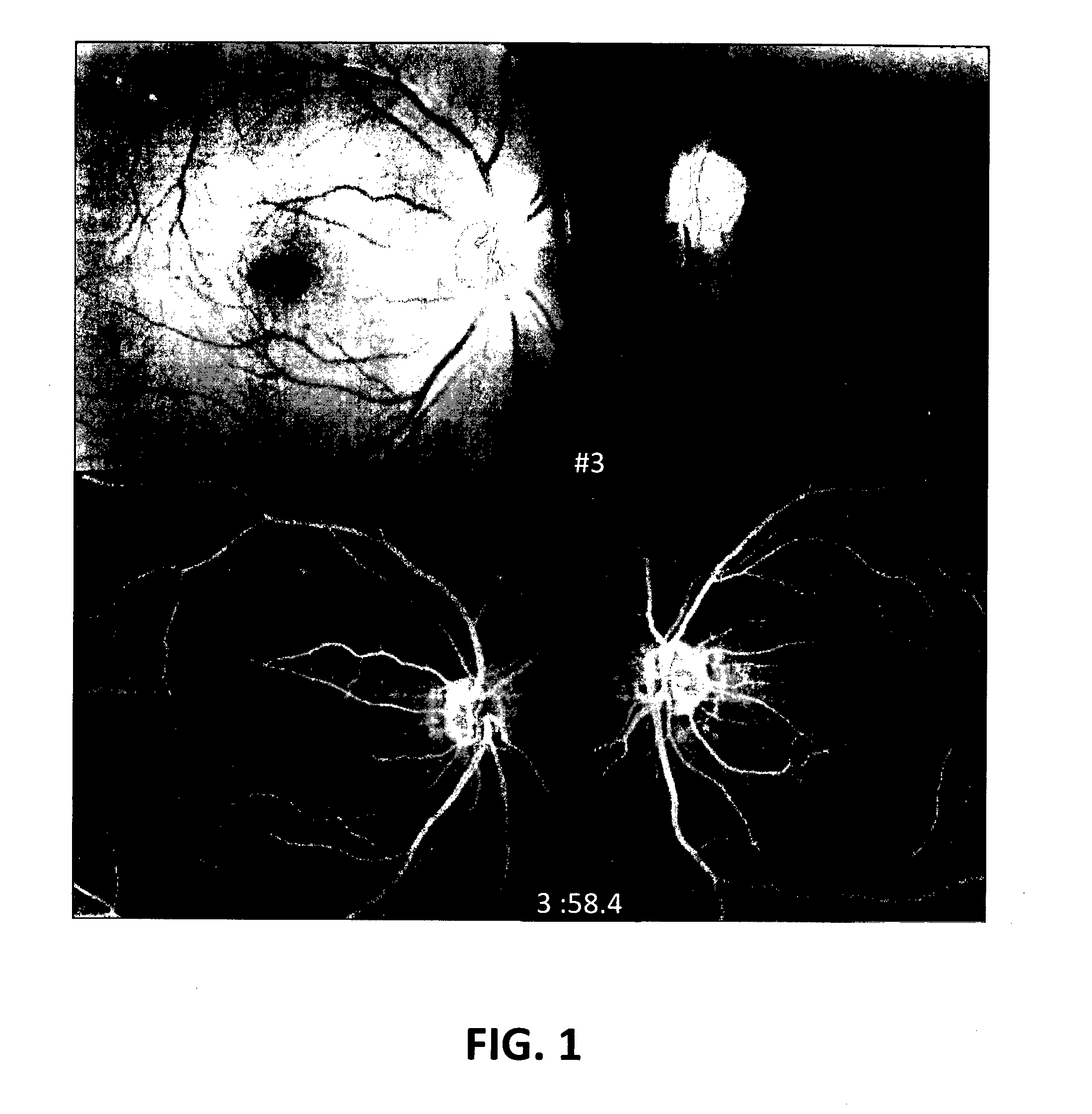 Angiotensin converting enzyme inhibitors for treating optic neuropathy or congenital optic atrophy