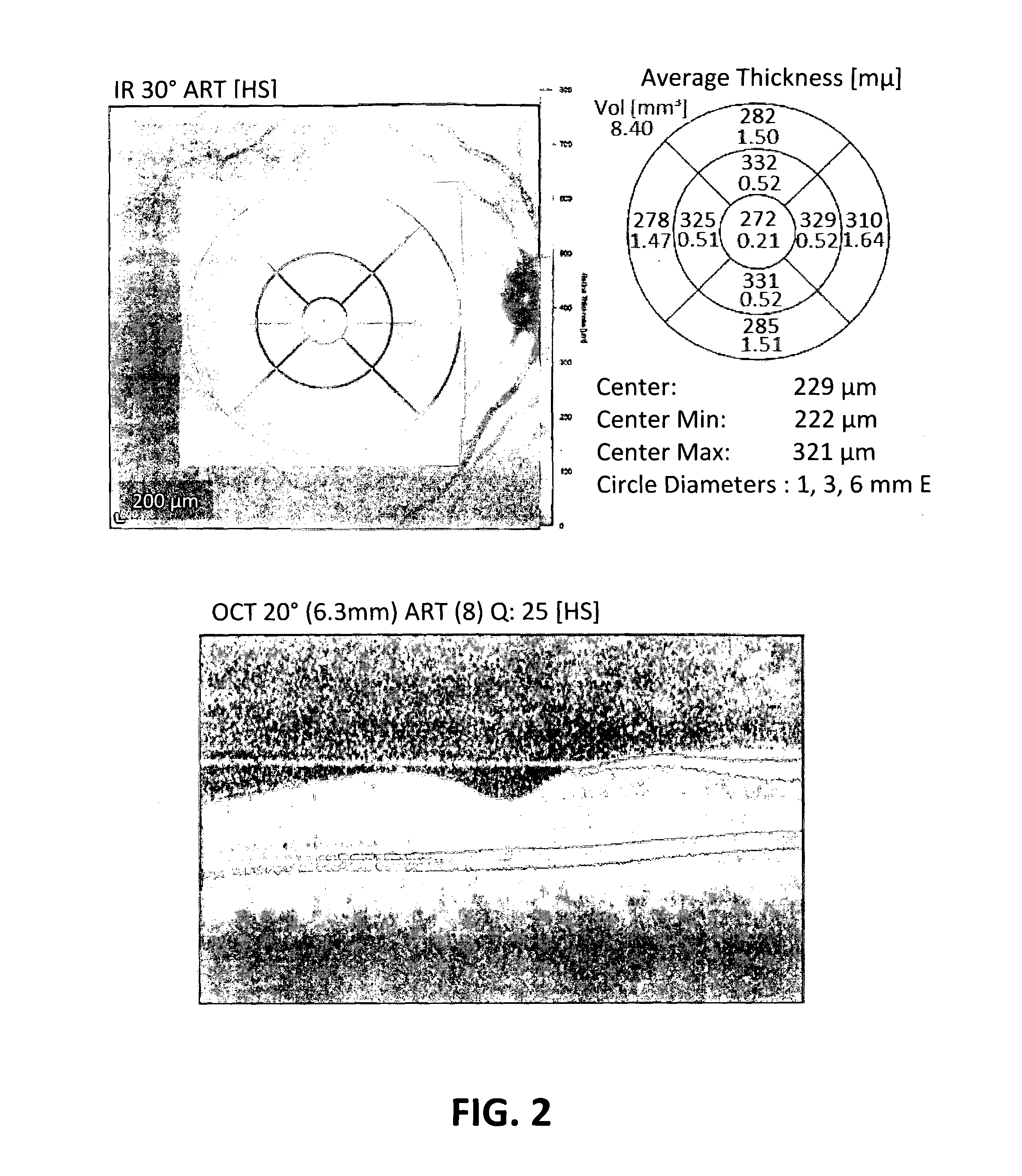 Angiotensin converting enzyme inhibitors for treating optic neuropathy or congenital optic atrophy