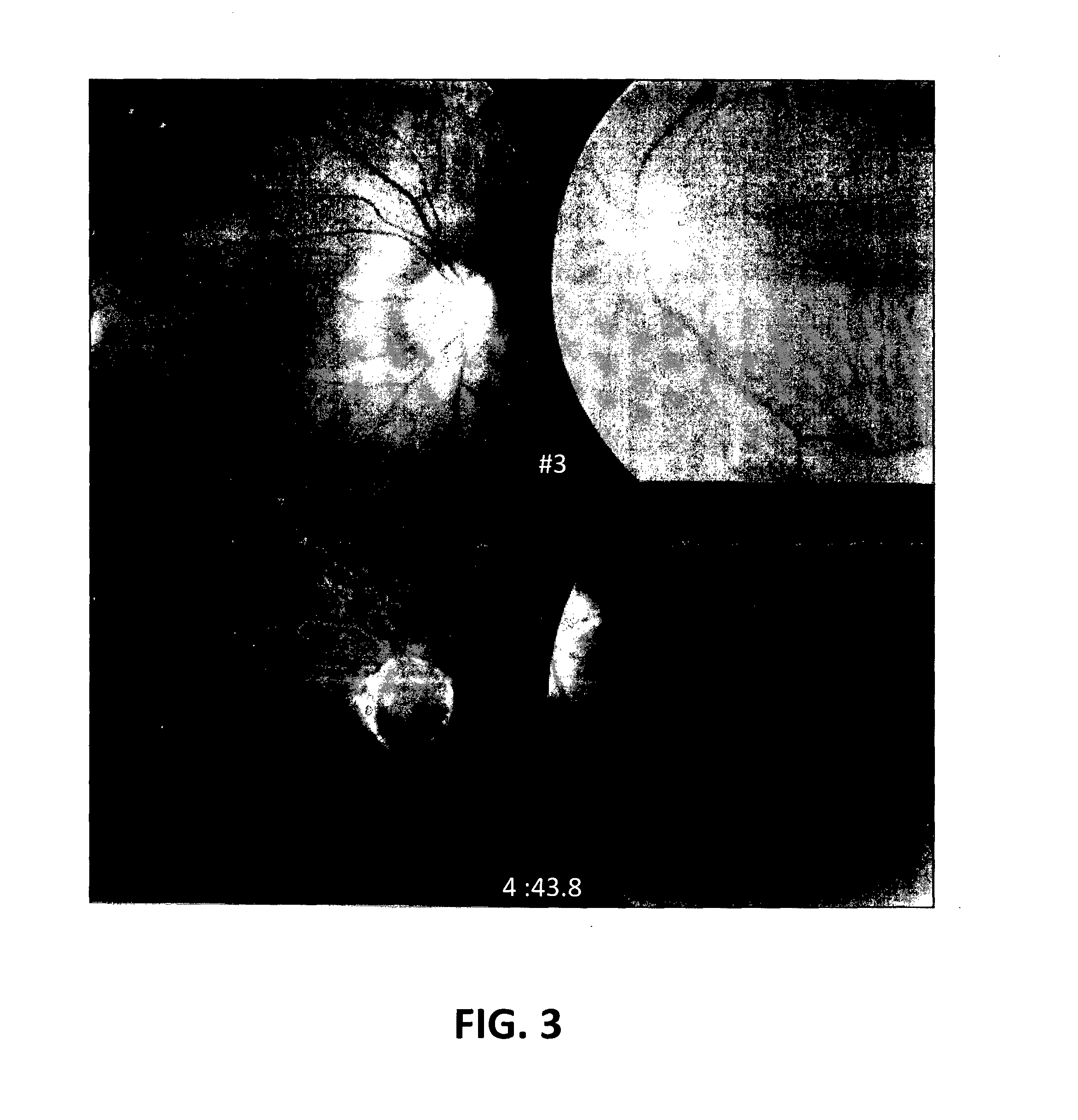 Angiotensin converting enzyme inhibitors for treating optic neuropathy or congenital optic atrophy