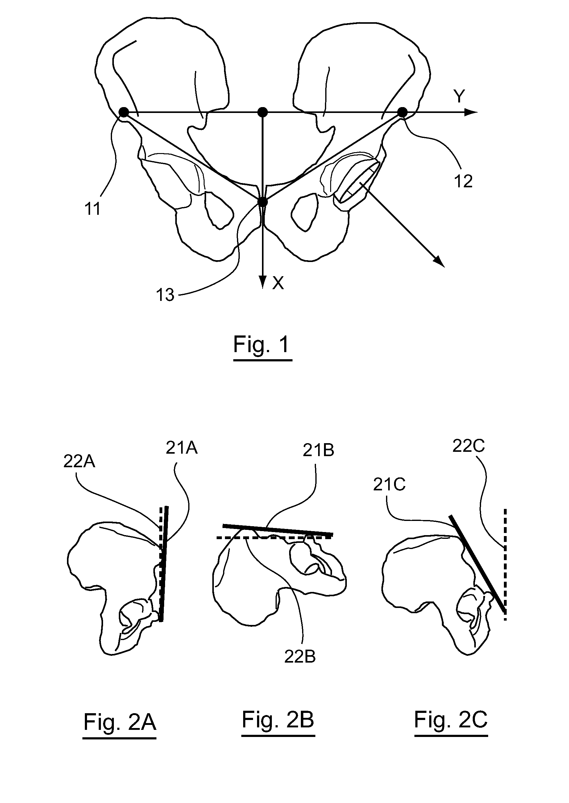 Help system for implanting a hip prosthesis on an individual