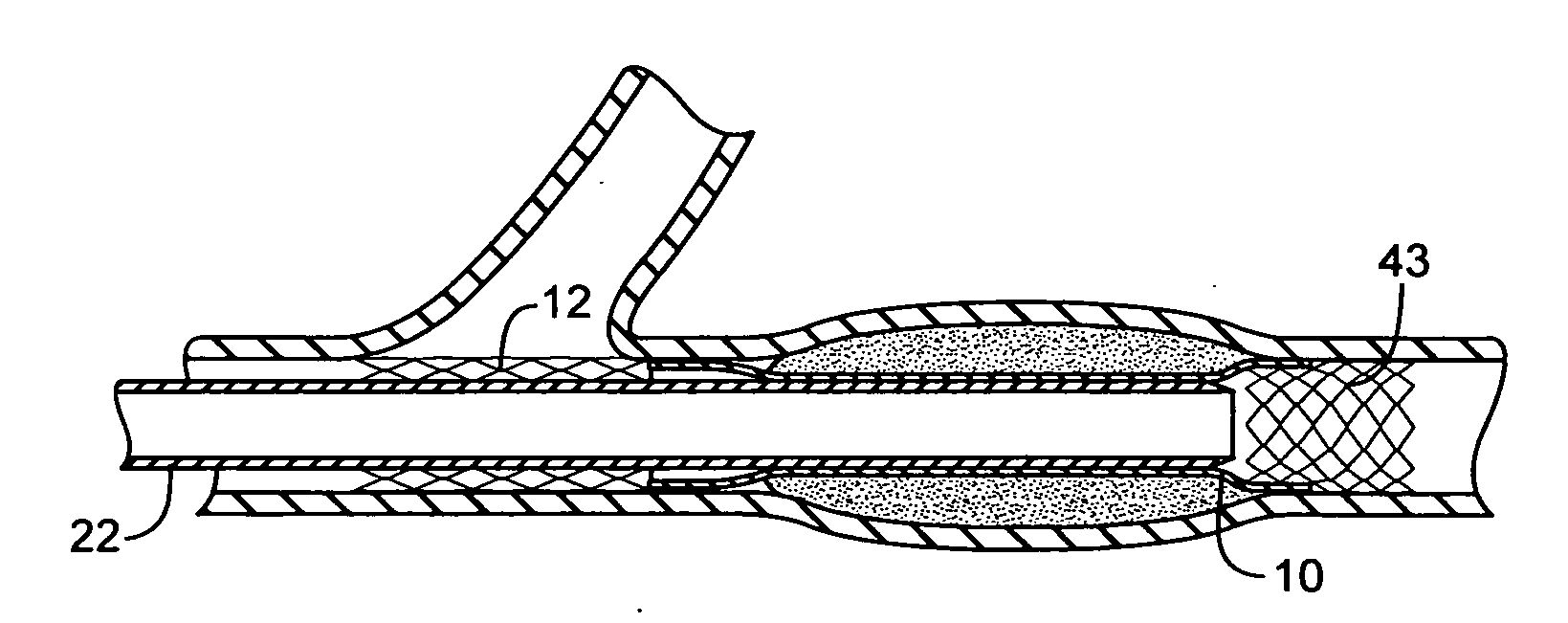 Methods and devices for protecting a passageway in a body when advancing devices through the passageway