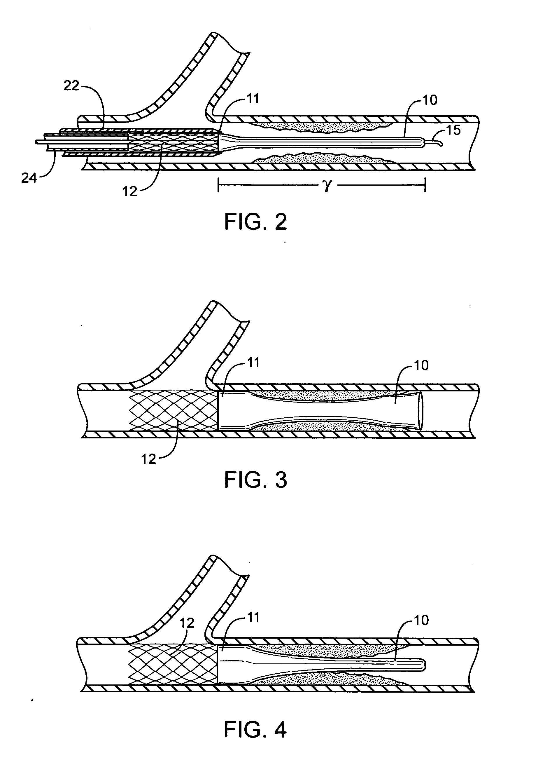 Methods and devices for protecting a passageway in a body when advancing devices through the passageway