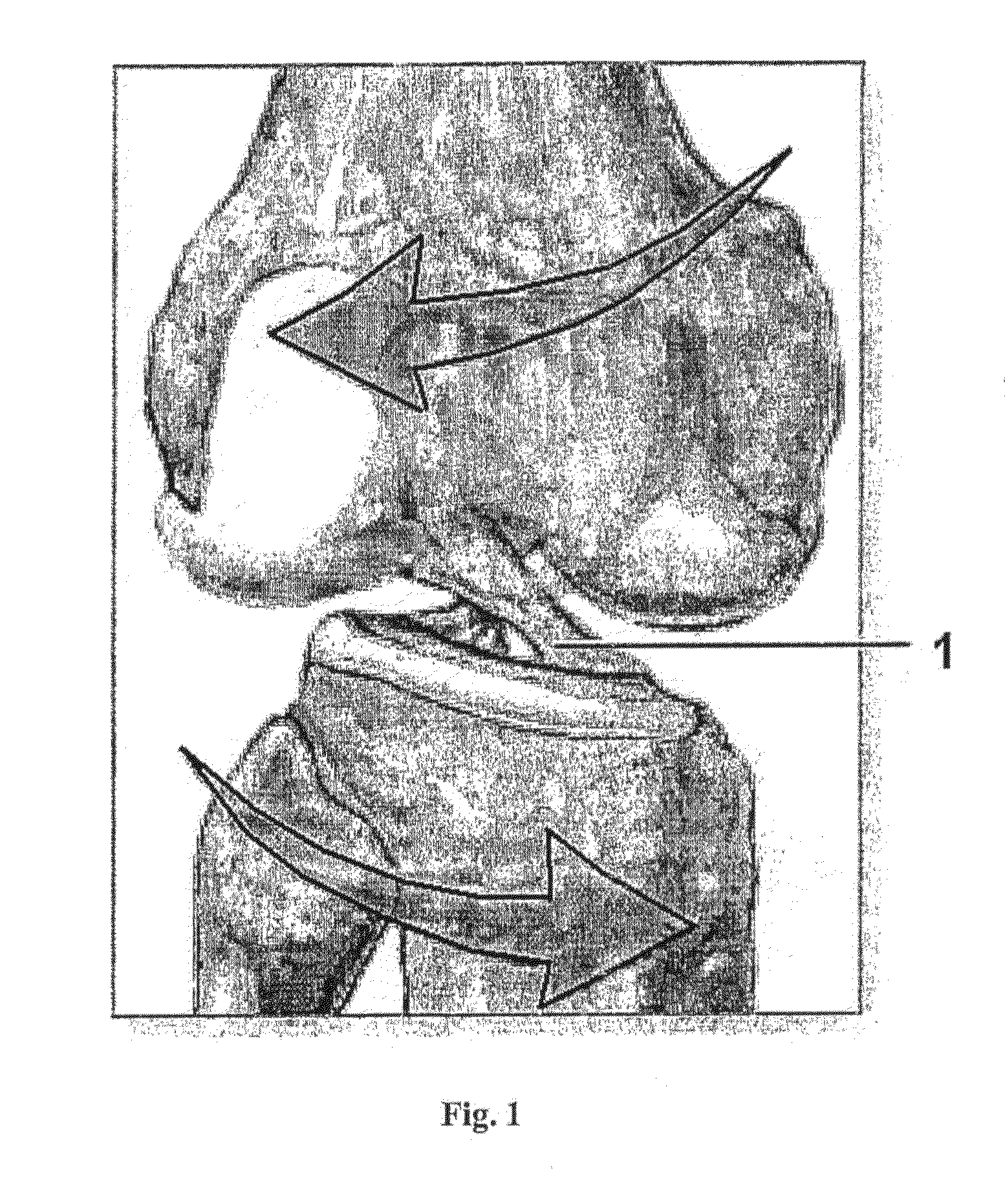 System and implant for ligament reconstruction or bone or bone reconstruction