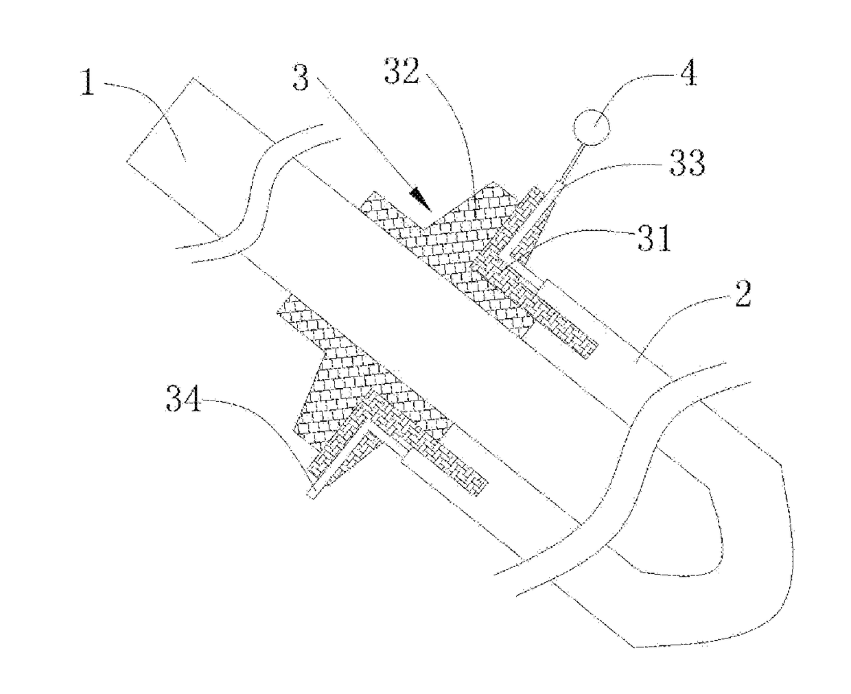 Cross-shaped double sleeve drainage tube