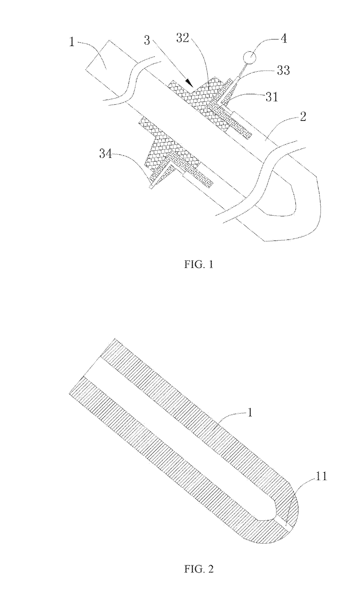 Cross-shaped double sleeve drainage tube