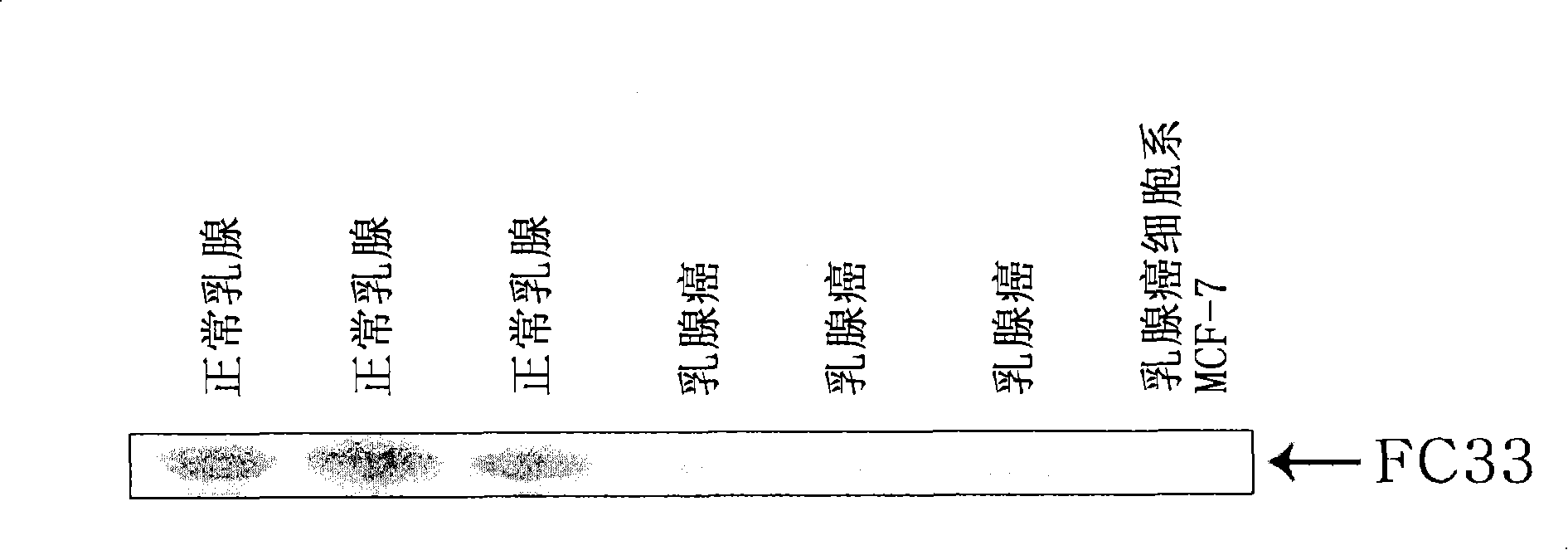 Human cancer suppressor gene, protein encoded therein