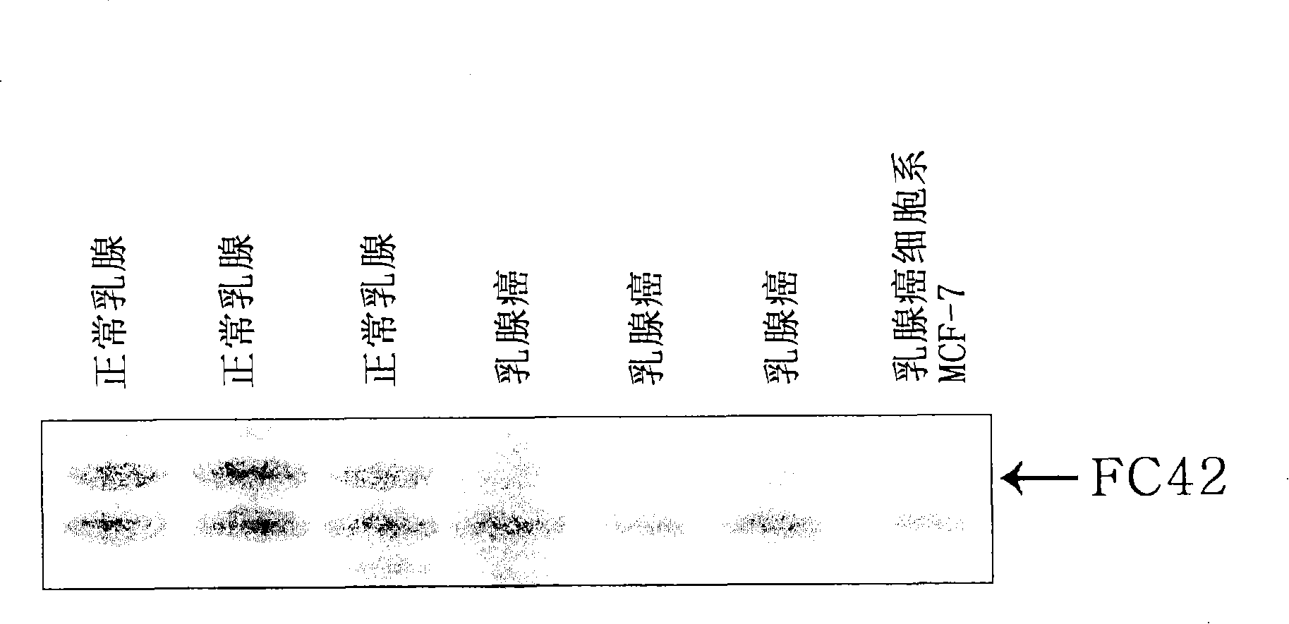 Human cancer suppressor gene, protein encoded therein