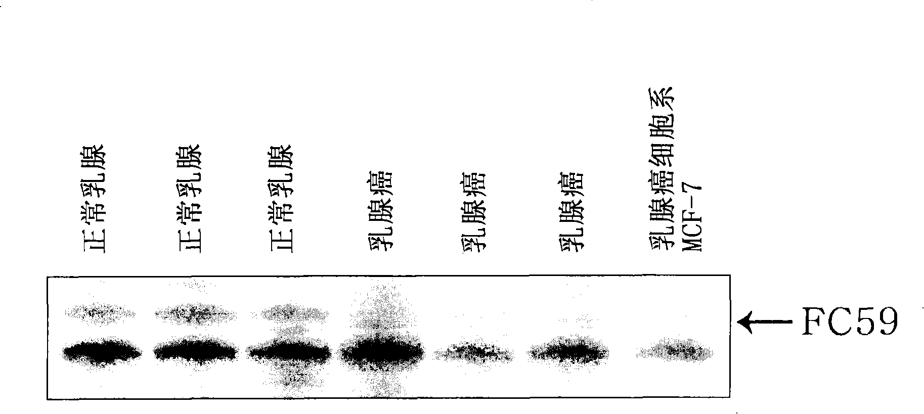 Human cancer suppressor gene, protein encoded therein