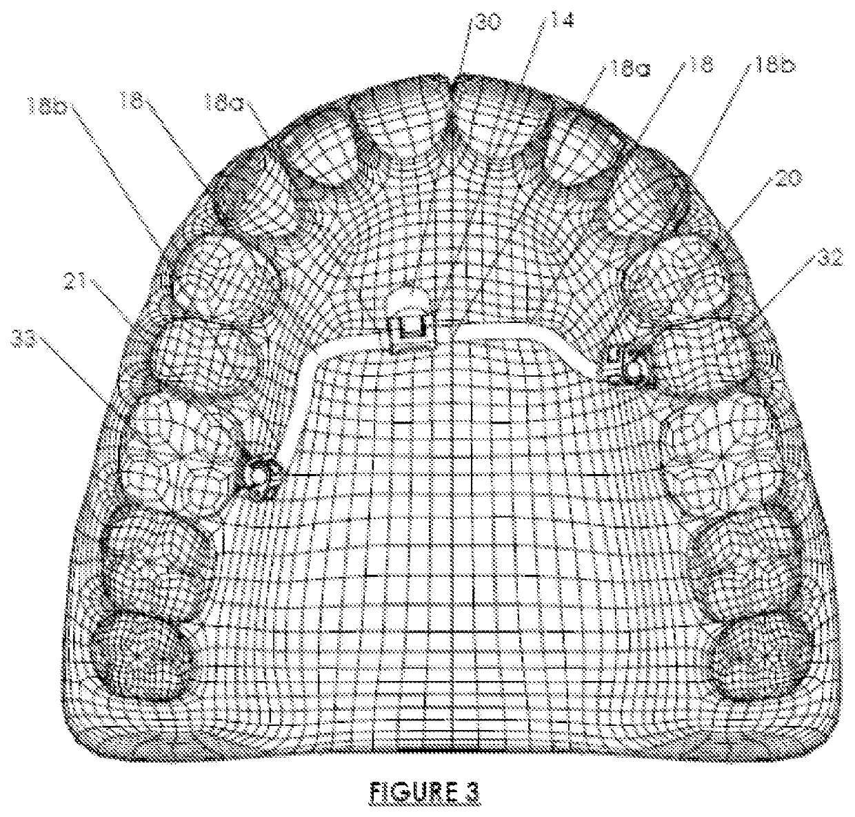 Orthodontic system anchoring method and apparatus