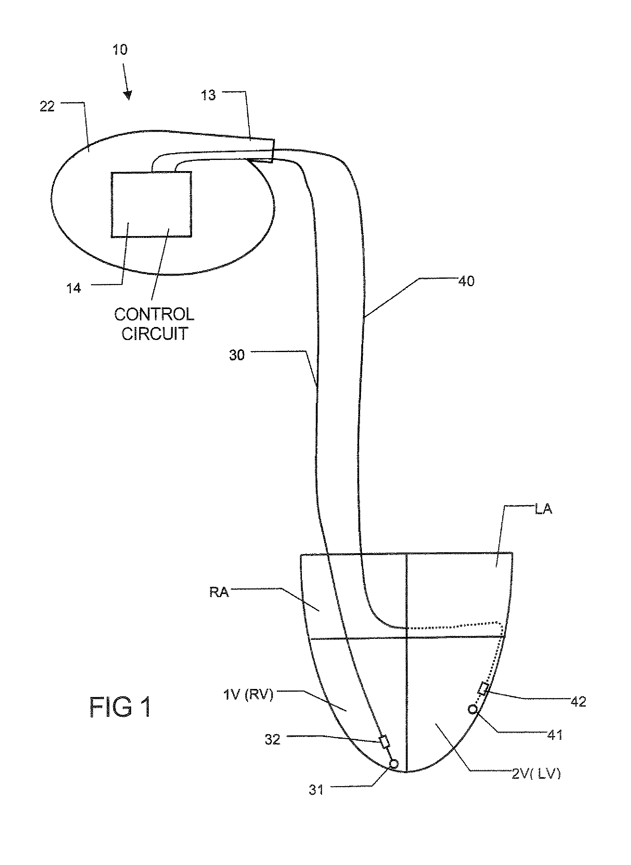 Bi-ventricular pacer, system and method