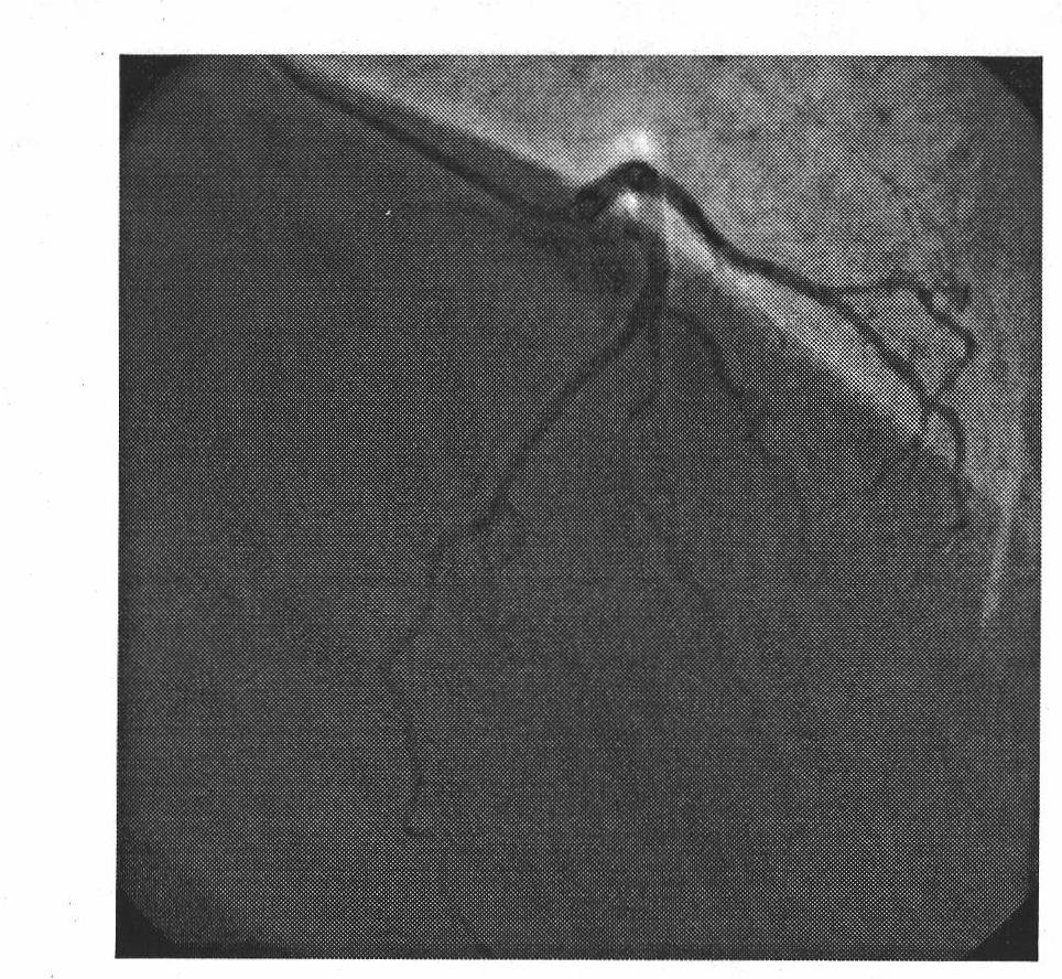 Dynamic three-dimensional reconstruction method of single-arm X-ray angiogram maps