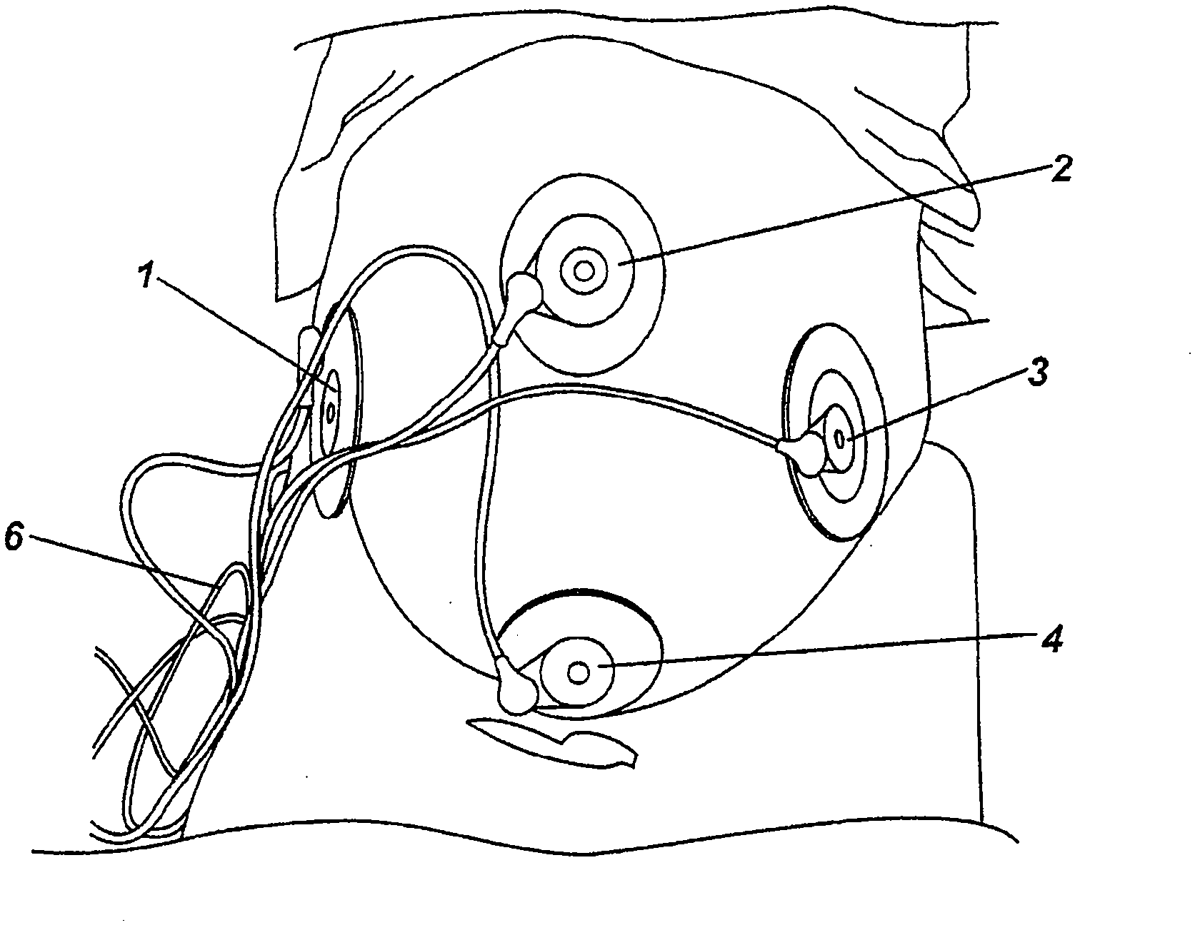 Electrode and electrode positioning arrangement for abdominal fetal electrocardiogram detection