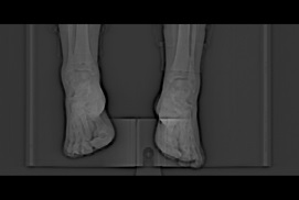 Method and system for training limb part recognition model in CT (Computed Tomography) image