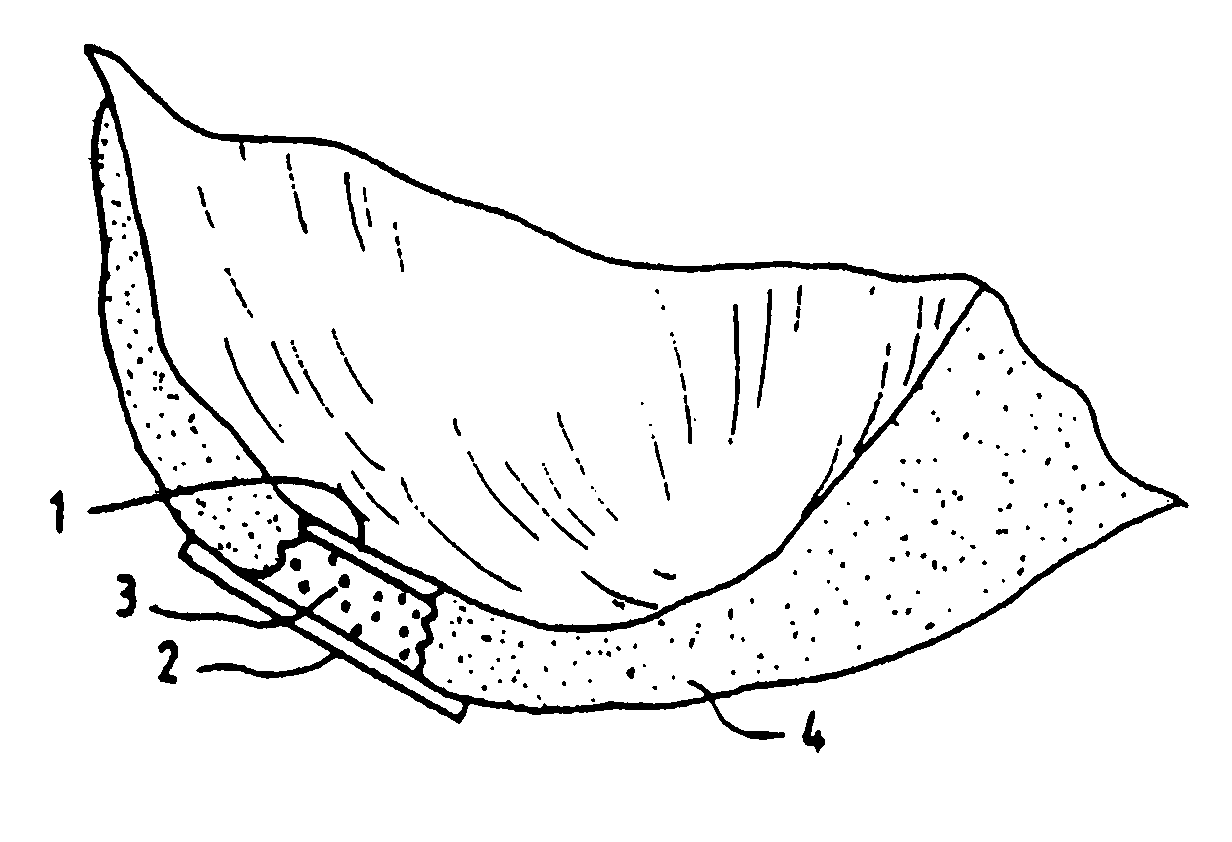 Method, instruments, and kit for autologous transplantation