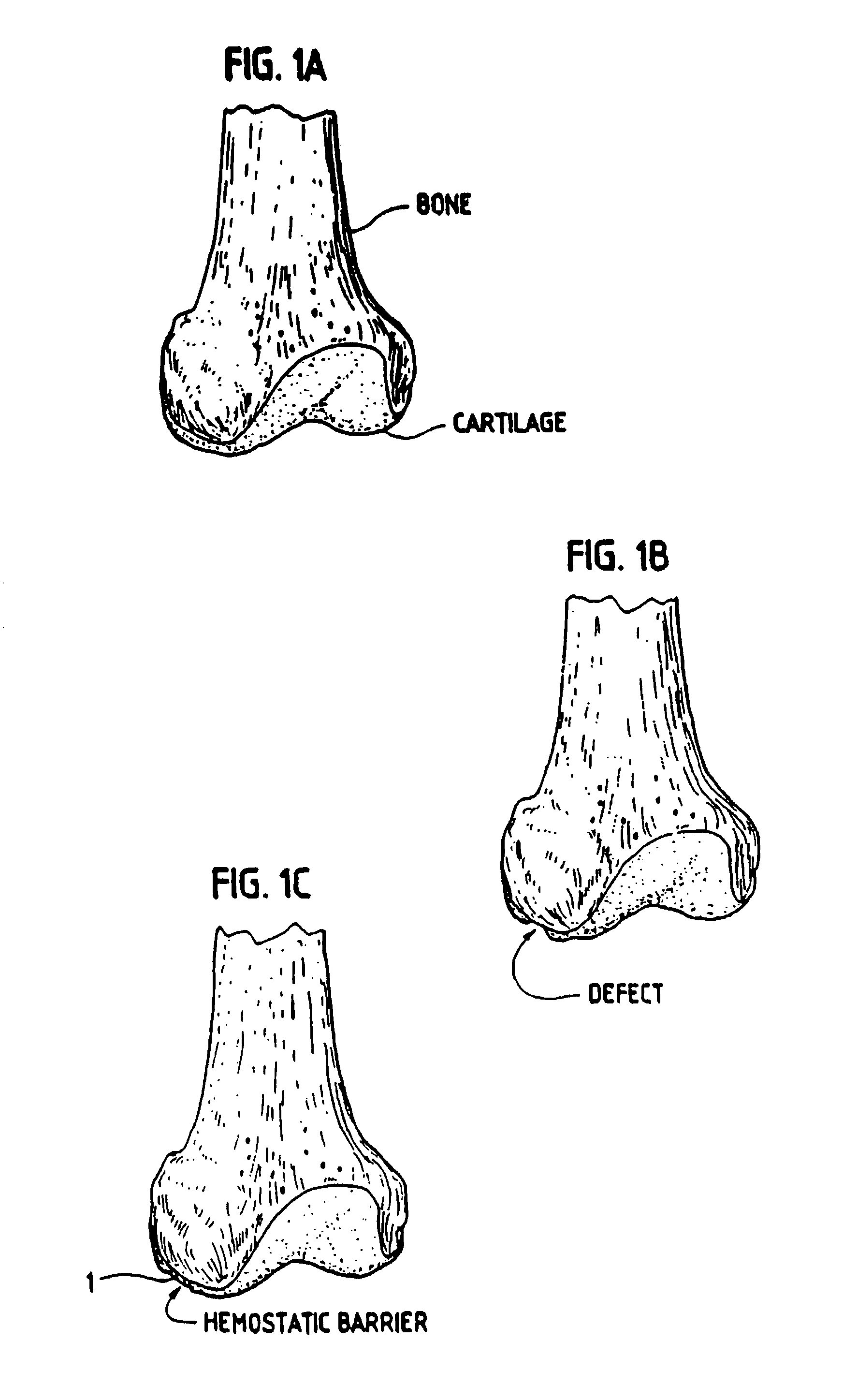 Method, instruments, and kit for autologous transplantation