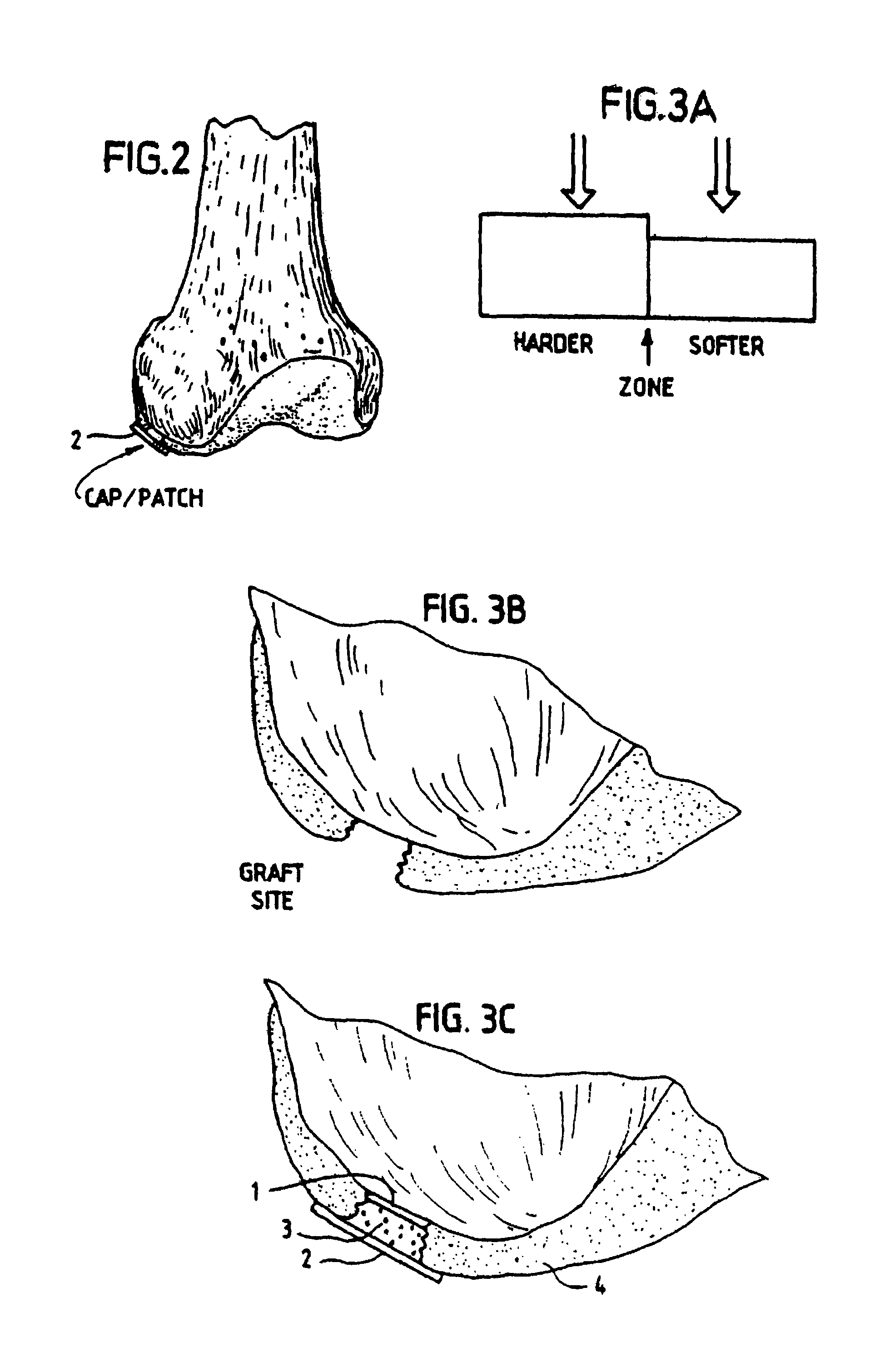 Method, instruments, and kit for autologous transplantation