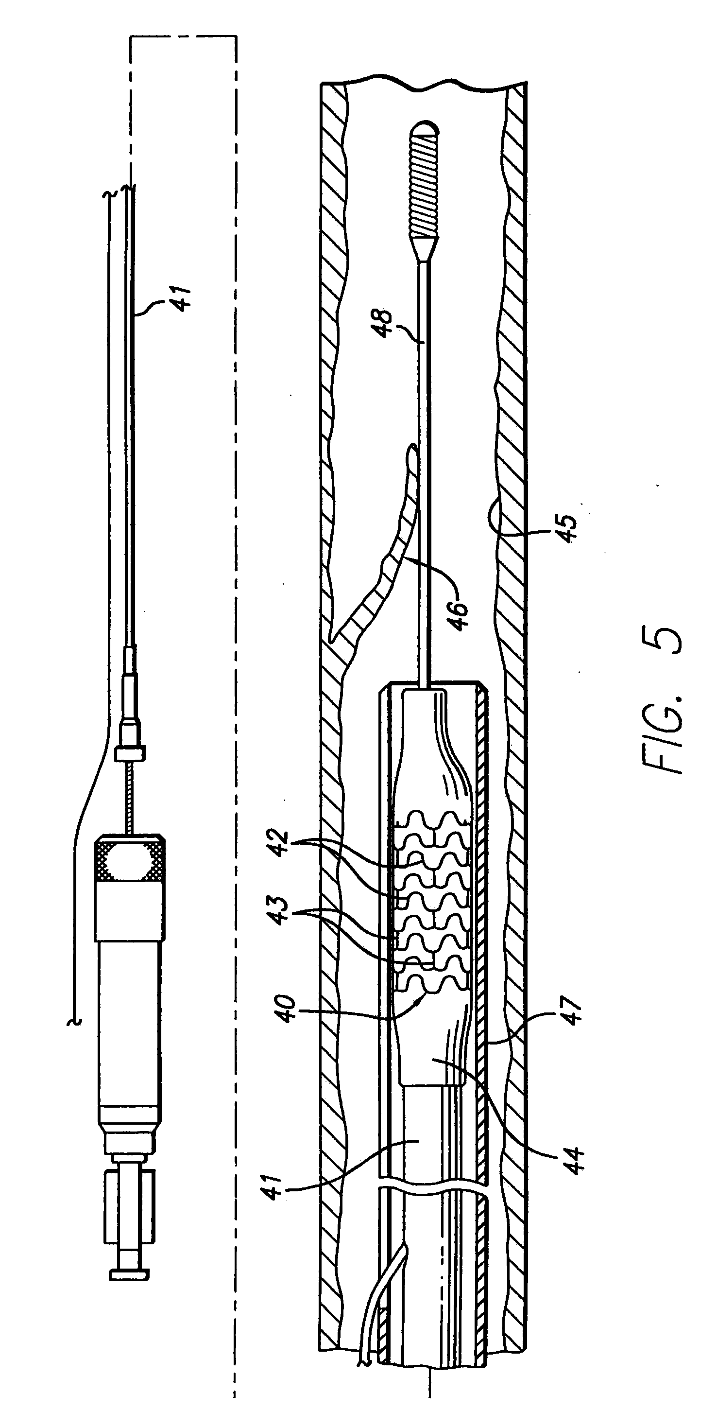 Multilayer stent