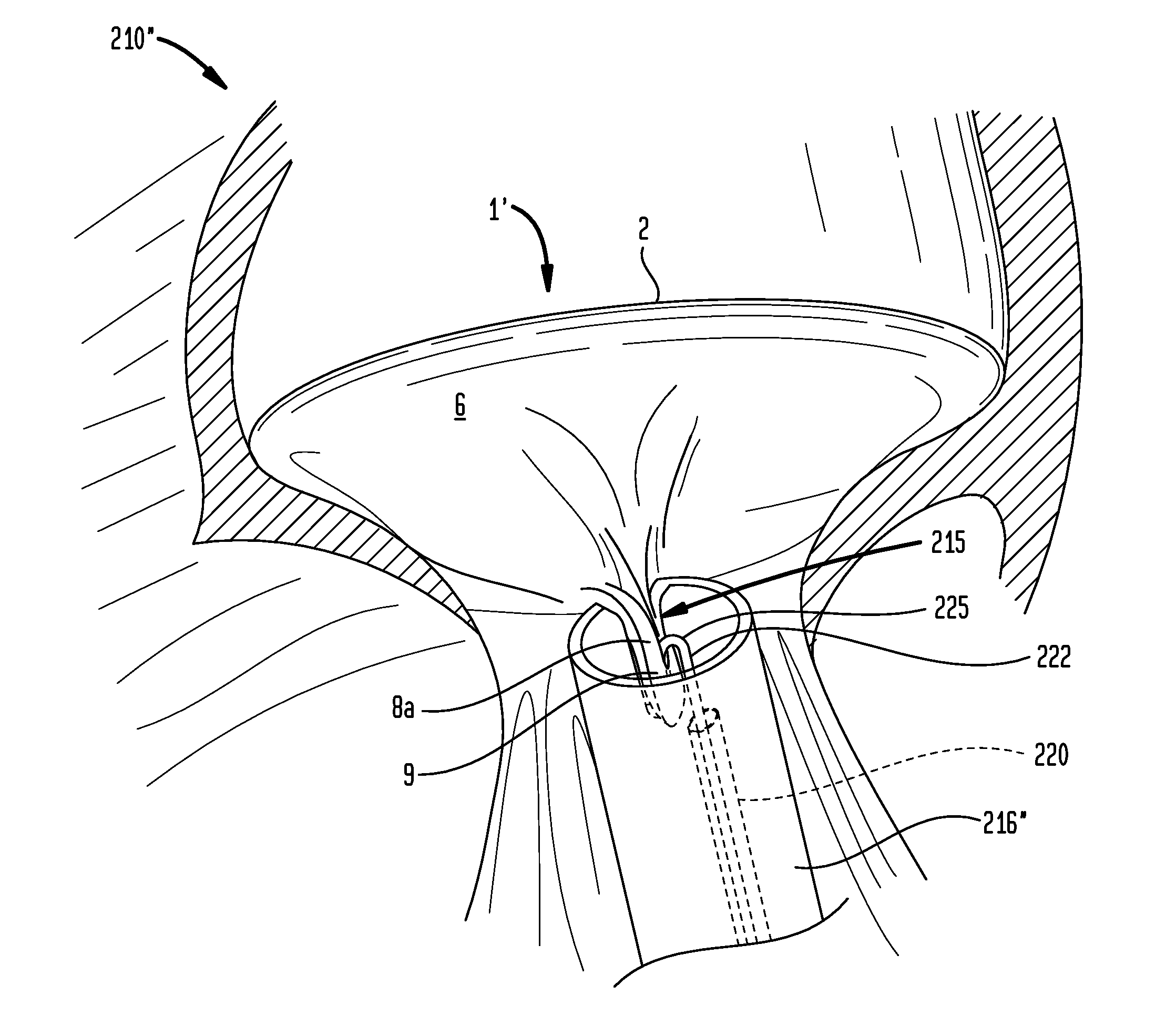 Apparatus and method for heart valve repair