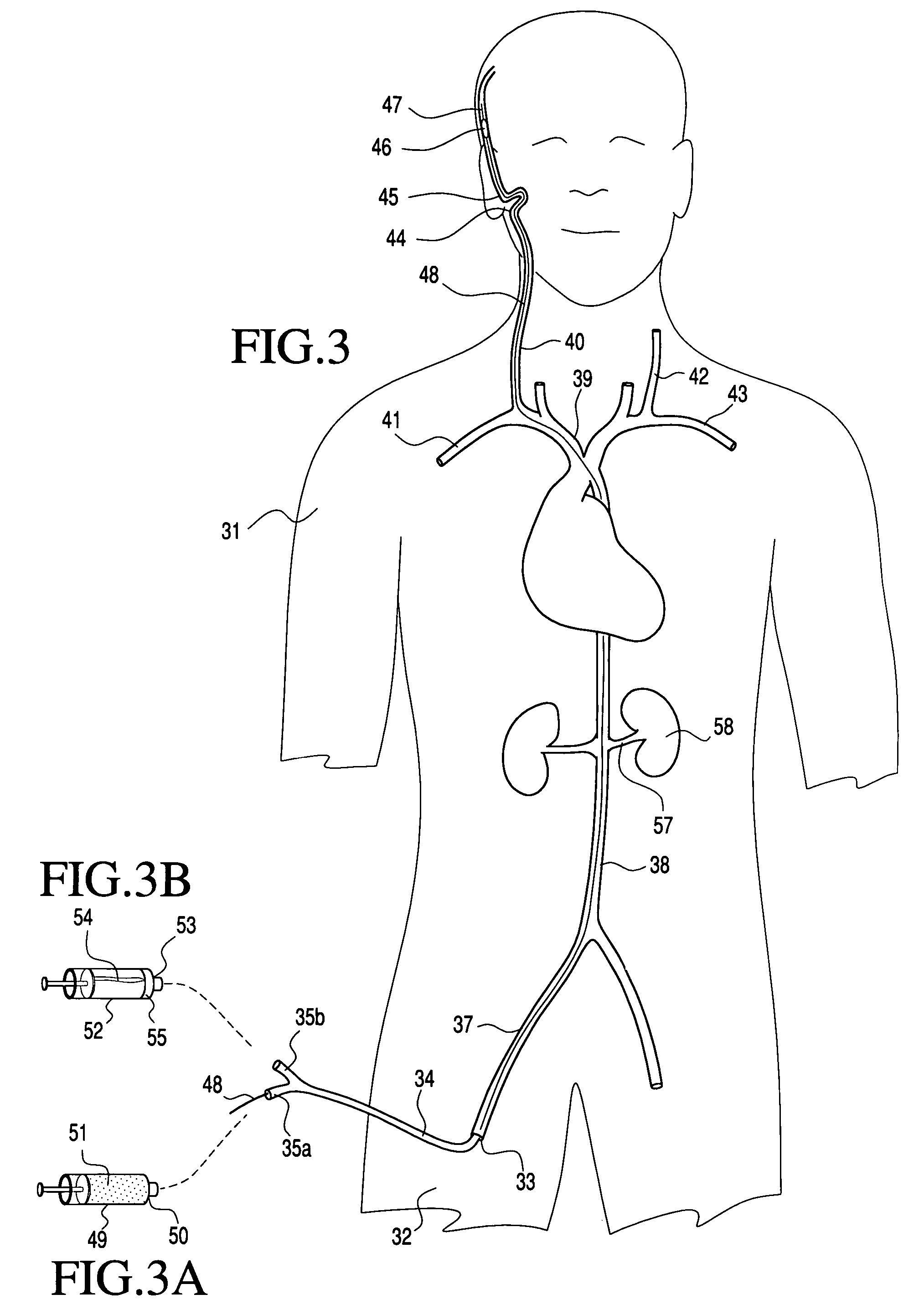 Transluminal application of adult stem cells for body organ tissue repair