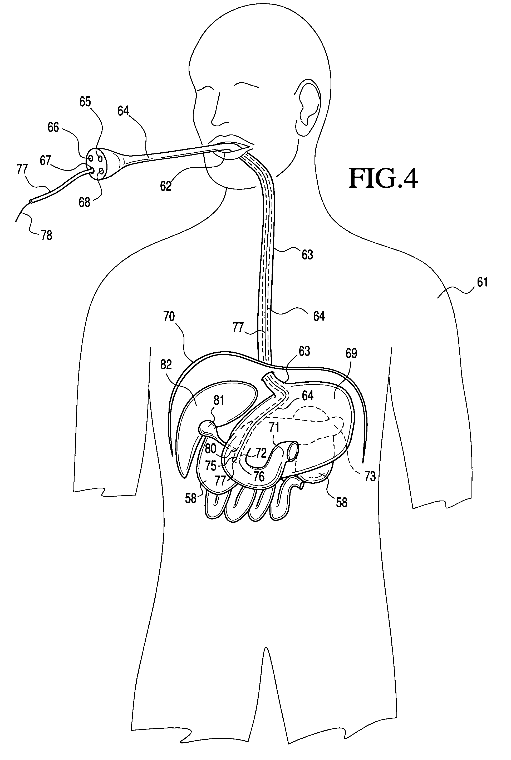 Transluminal application of adult stem cells for body organ tissue repair