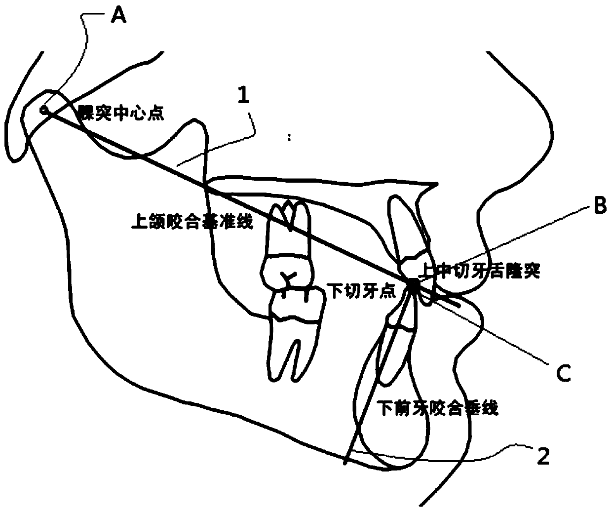 Orthodontic correction auxiliary device used for anterior teeth, and orthodontic correction device