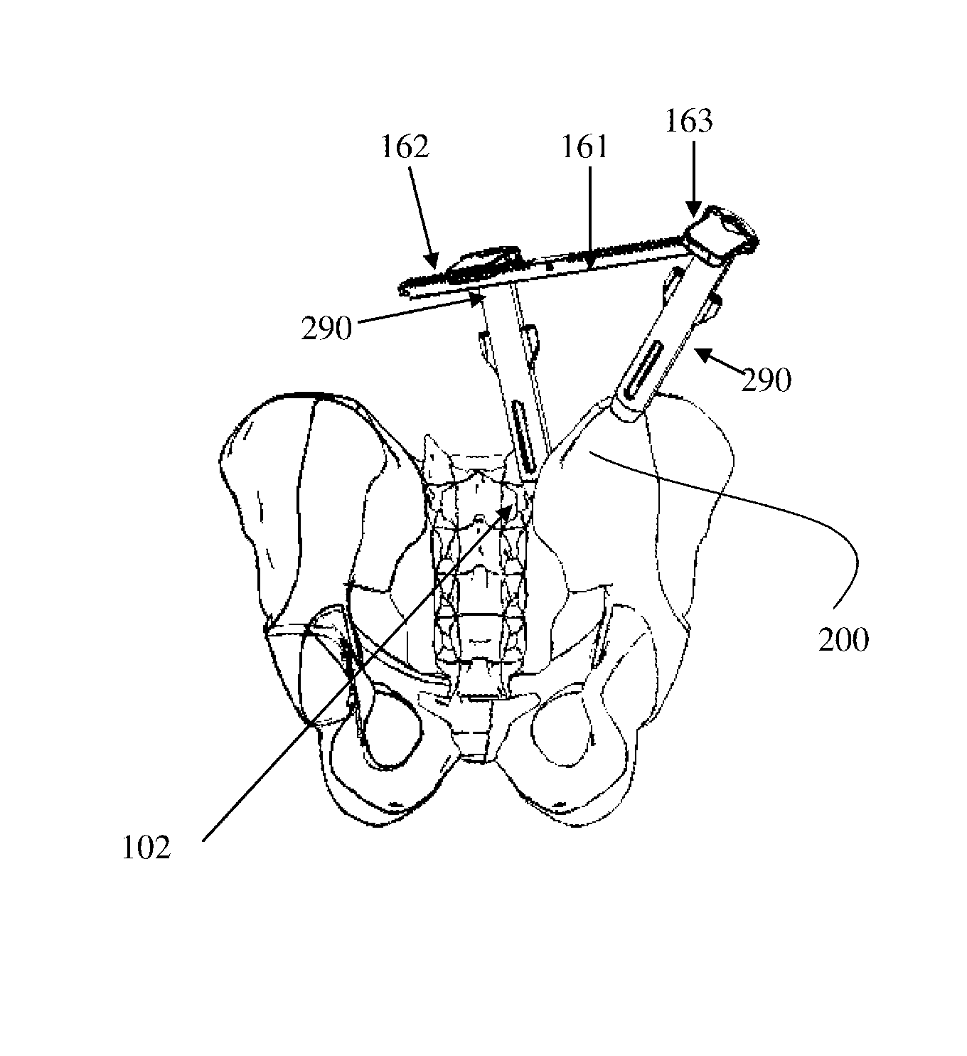 Method and implant system for sacroiliac joint fixation and fusion