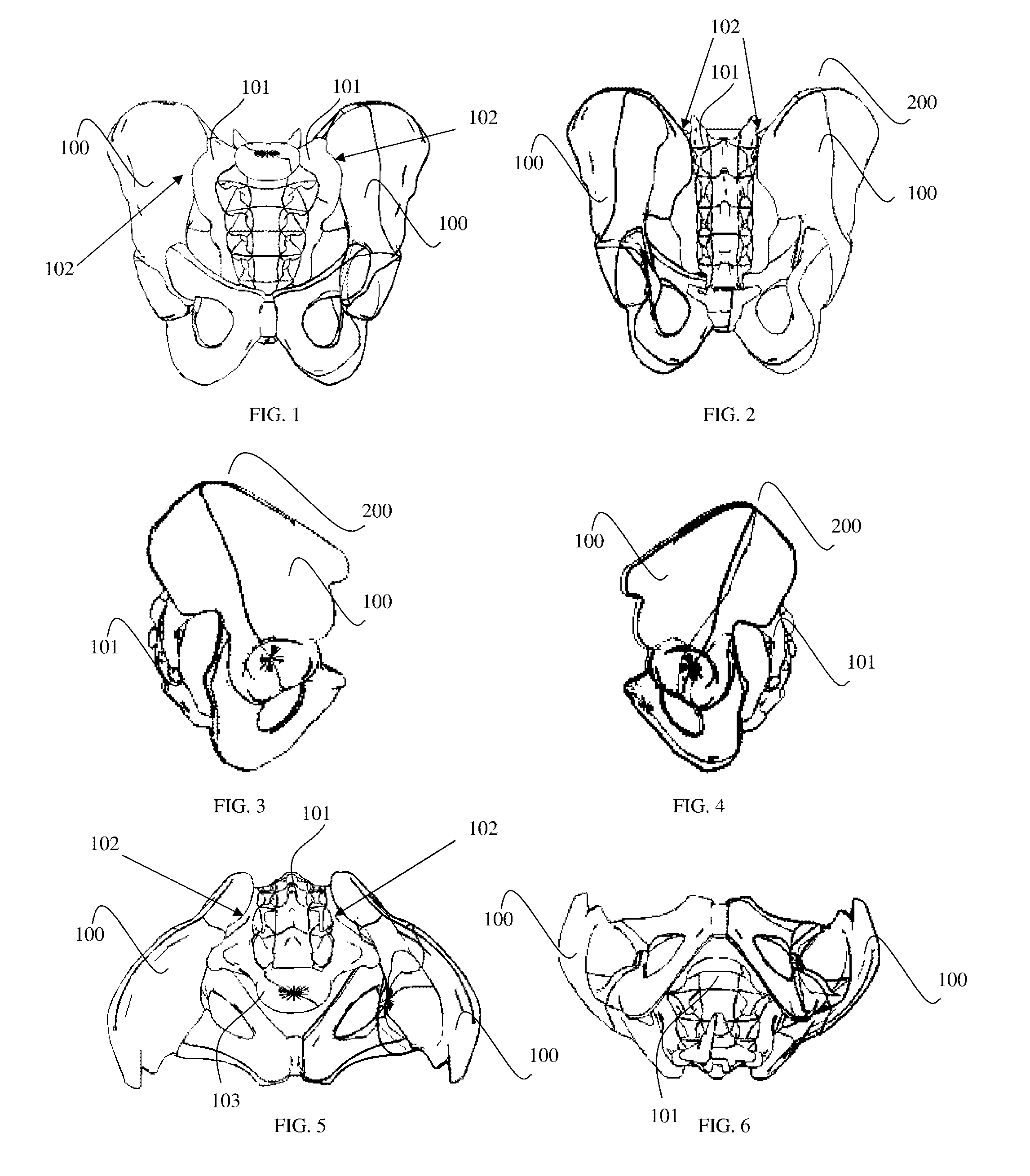 Method and implant system for sacroiliac joint fixation and fusion