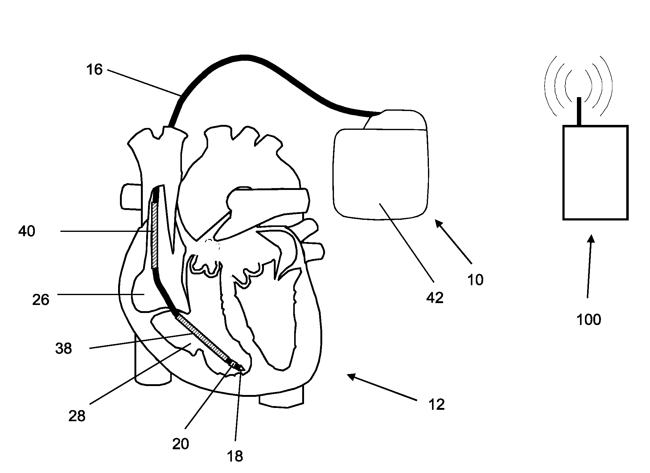 Implantable medical device