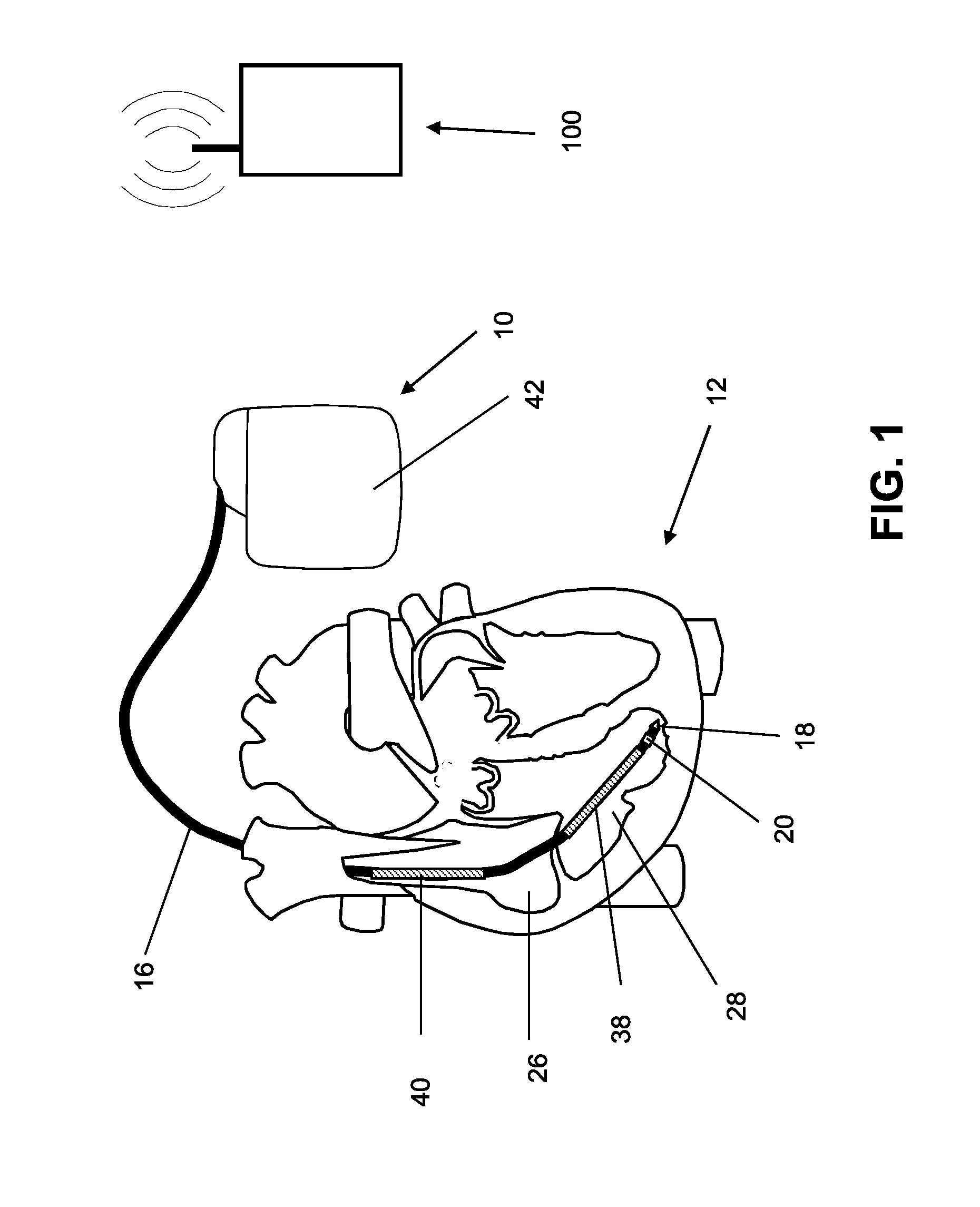 Implantable medical device