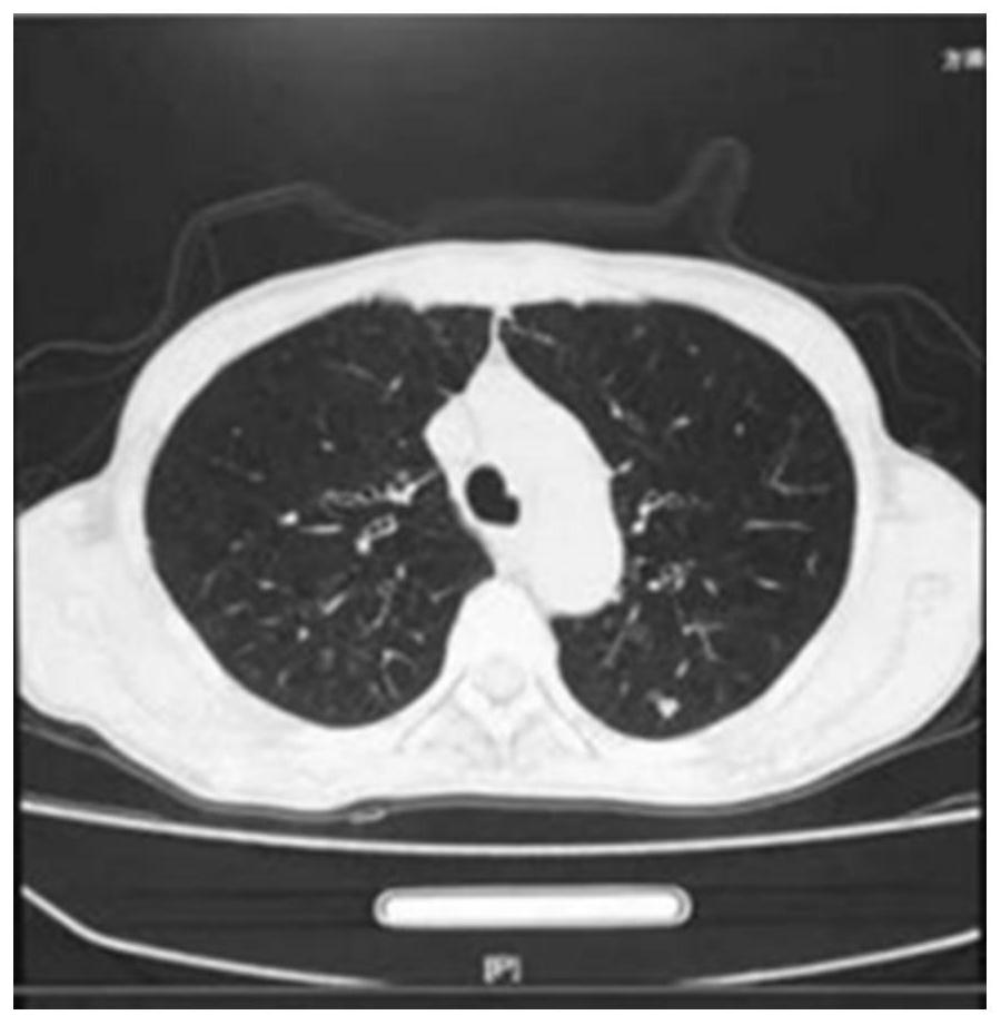 Pharmaceutical composition for treating COPD accompanied by pulmonary fibrosis