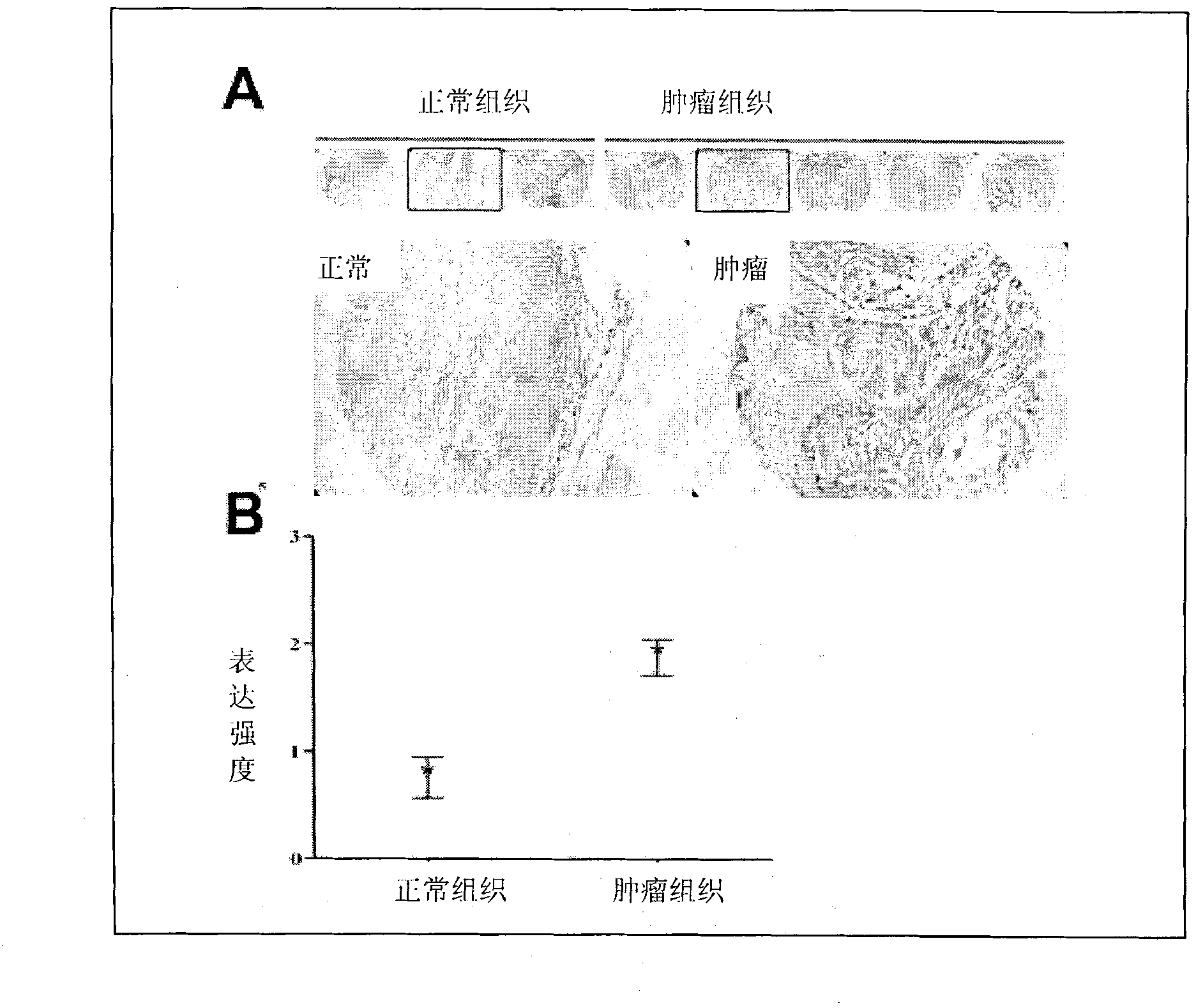 Application of ADAM12m used as tumor marker and target molecule in diagnosing and treating tumors