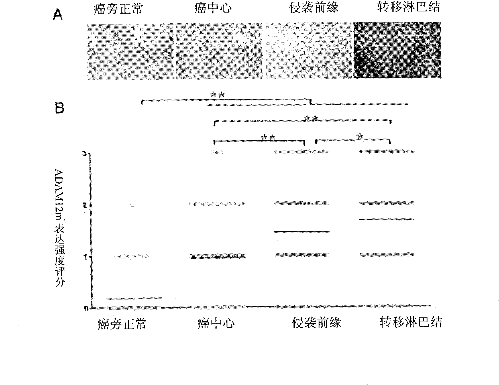 Application of ADAM12m used as tumor marker and target molecule in diagnosing and treating tumors