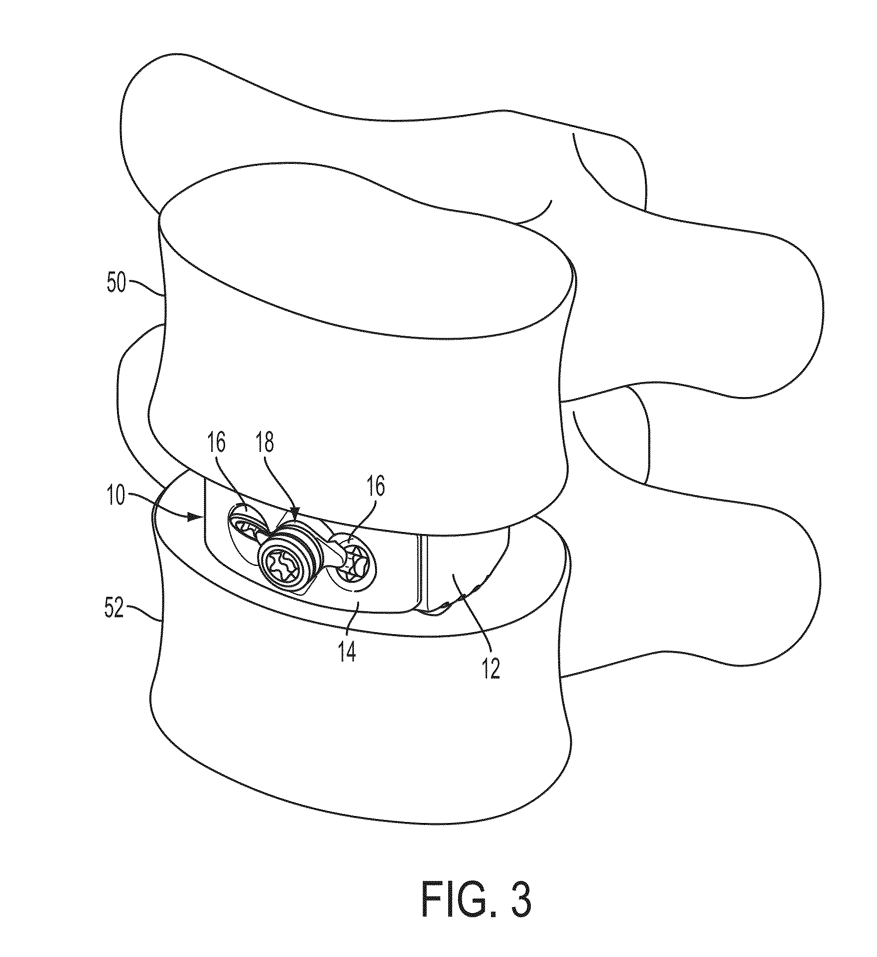 Interbody fusion device and associated methods