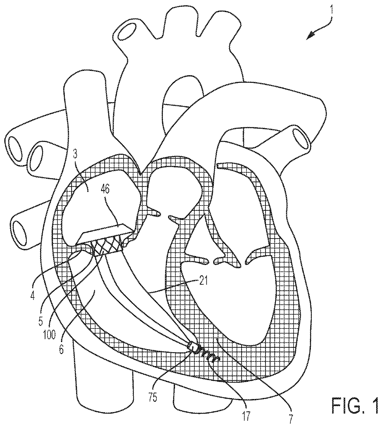 Transcatheter atrial anchors and methods of implantation