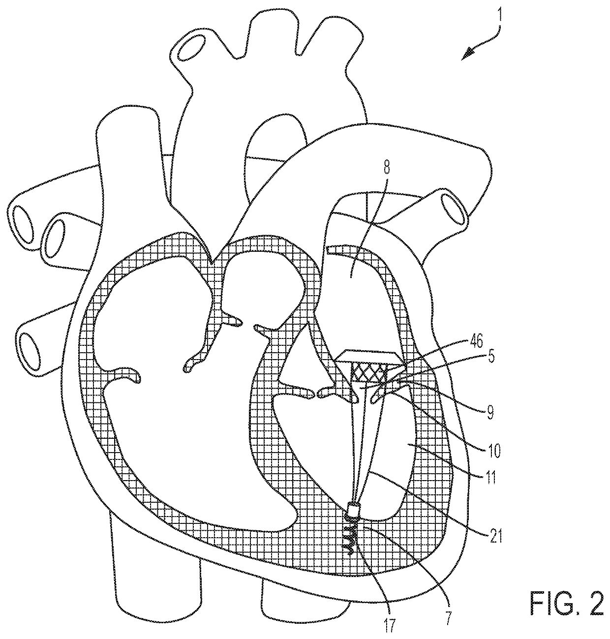 Transcatheter atrial anchors and methods of implantation