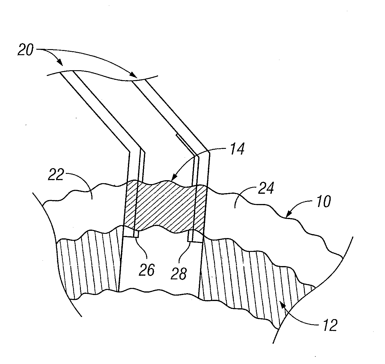 Method and Apparatus for RF Anastomosis