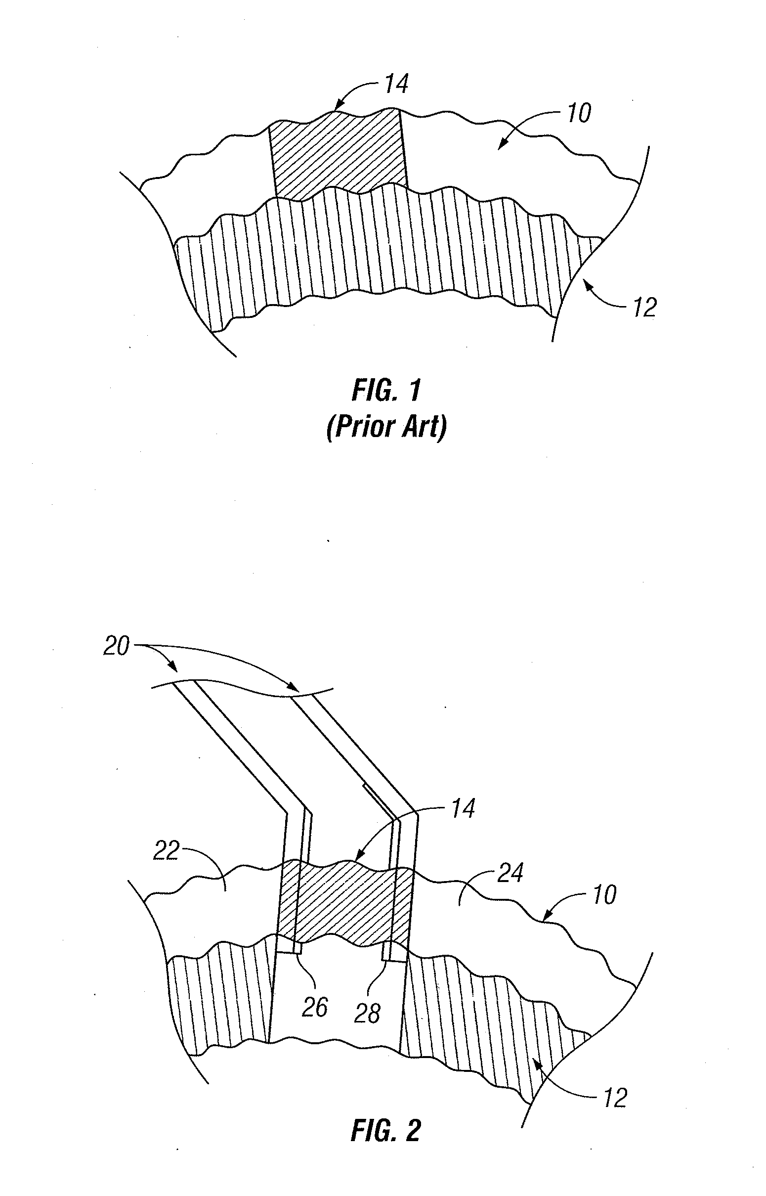 Method and Apparatus for RF Anastomosis