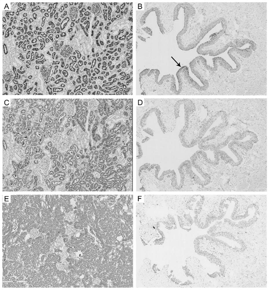 Marker for predicting range and depth of kidney infection of polyoma virus and application thereof